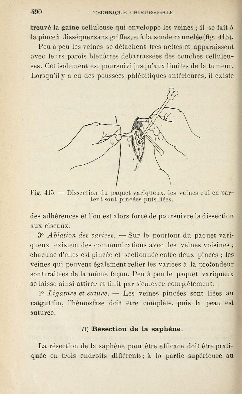 trouvé la gaine celluleuse qui enveloppe les veines ; il se fait à la pince à disséquer sans griffes, et à la sonde cannelée (fîg. 415). Peu à peu les veines se détachent très nettes et apparaissent avec leurs parois bleuâtres débarrassées des couches celluleu- ses. Cet isolement est poursuivi jusqu'aux limites de la tumeur. Lorsqu'il y a eu des poussées phlébitiques antérieures, il existe Fig. 415. — Dissection du paquet variqueux, les veines qui en par- tent sont pincées puis liées. des adhérences et l'on est alors forcé de poursuivre la dissection aux ciseaux. 3^ Ablation des varices. — Sur le pourtour du paquet vari- queux existent des communications avec les veines voisines , chacune d'elles est pincée et sectionnée entre deux pinces ; les veines qui peuvent également relier les varices à la profondeur sont traitées de la même façon. Peu à peu le paquet variqueux se laisse ainsi attirer et finit par s'enlever complètement. 4° Ligature et suture. — Les veines pincées sont liées au catgut fin, l'hémostase doit être complète, puis la peau est suturée. B) Résection de la saphène. La résection de la saphène pour être efficace doit être prati- quée en trois endroits différents; à la partie supérieure au