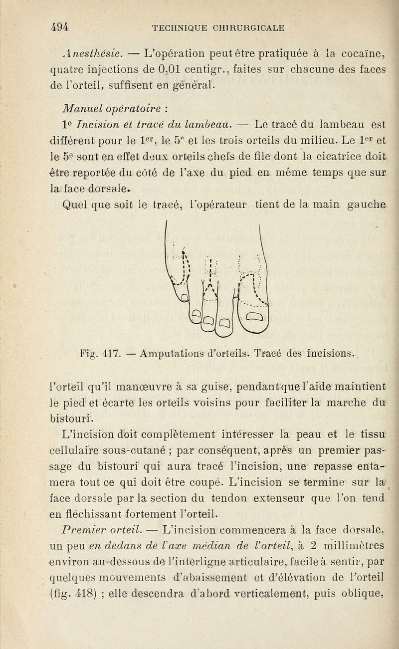 Anesthésie. — L'opération peut être pratiquée à la cocaïne, quatre injections de 0,01 centigr., faites sur chacune des faces de l'orteil, suffisent en général. Manuel opératoire : 1° Incision et tracé du lambeau. — Le tracé du lambeau est différent pour le l*^'^, le 5^ et les trois orteils du milieu. Le 1^^ et le 5® sont en effet deux orteils chefs de file dont la cicatrice doit être reportée du côté de l'axe du pied en même temps que sur la face dorsale^ Quel que soit le tracé, l'opérateur tient de la main gauche Fig. 417. — Amputations d'orteils. Tracé des incisions. l'orteil qu'il manœuvre à sa guise, pendant que Taide maintient le pied et écarte les orteils voisins pour faciliter la marche du bistouri. L'incision doit complètement intéresser la peau et le tissu cellulaire sous-cutané ; par conséquent, après un premier pas- sage du bistouri qui aura tracé l'incision, une repasse enta- mera tout ce qui doit être coupé. L'incision se termine sur la face dorsale par la section du tendon extenseur que Ton tend en fléchissant fortement l'orteil. Premier orteil. — L'incision commencera à la face dorsale, un peu en dedans de l'axe médian de Vorteil, à 2 millimètres environ au-dessous de l'interligne articulaire, facile à sentir, par quelques mouvements d'abaissement et d'élévation de l^orteil (fig. 418) ; elle descendra d'abord verticalement, puis oblique,