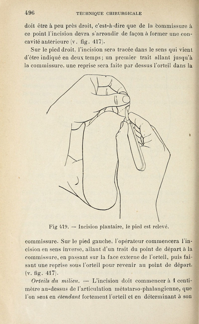 doit être à peu près droit, c'est-à-dire que de la commissure à ce point l'incision devra s'arrondir de façon à former une con- cavité antérieure (v. fîg. 417). Sur le pied droit, l'incision sera tracée dans le sens qui vient d'être indiqué en deux temps ; un premier trait allant jusqu'à la commissure, une reprise sera faite par dessus l'orteil dans la Fig 419. Incision plantaire, le pied est relevé. commissure. Sur le pied gauche, l'opérateur commencera l'in- cision en sens inverse, allant d'un trait du point de départ à la commissure, en passant sur la face externe de l'orteil, puis fai- sant une reprise sous l'orteil pour revenir au point de départ. (v. fîg. 417). Orteils du milieu. — L'incision doit commencer à 1 centi- mètre au-dessus de l'articulation métatarso-phalangienne, que l'on sent en étendant fortement l'orteil et en déterminant à son