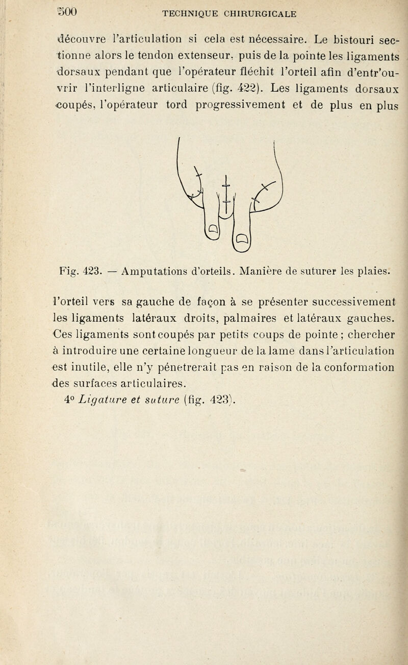 soo découvre l'articulation si cela est nécessaire. Le bistouri sec- tionne alors le tendon extenseur, puis de la pointe les ligaments dorsaux pendant que l'opérateur fléchit l'orteil afin d'entr'ou- vrir l'interligne articulaire (tîg. 422). Les ligaments dorsaux coupés, l'opérateur tord progressivement et de plus en plus Fig. 423. — Amputations d'orteils. Manière de suturer les plaies. l'orteil vers sa gauche de façon à se présenter successivement les ligaments latéraux droits, palmaires et latéraux gauches. Ces ligaments sont coupés par petits coups de pointe; chercher à introduire une certaine longueur de la lame dans Tarticulation est inutile, elle n'y pénétrerait pas en raison de la conformation des surfaces articulaires. 4^ Ligature et suture (fîg. 423).