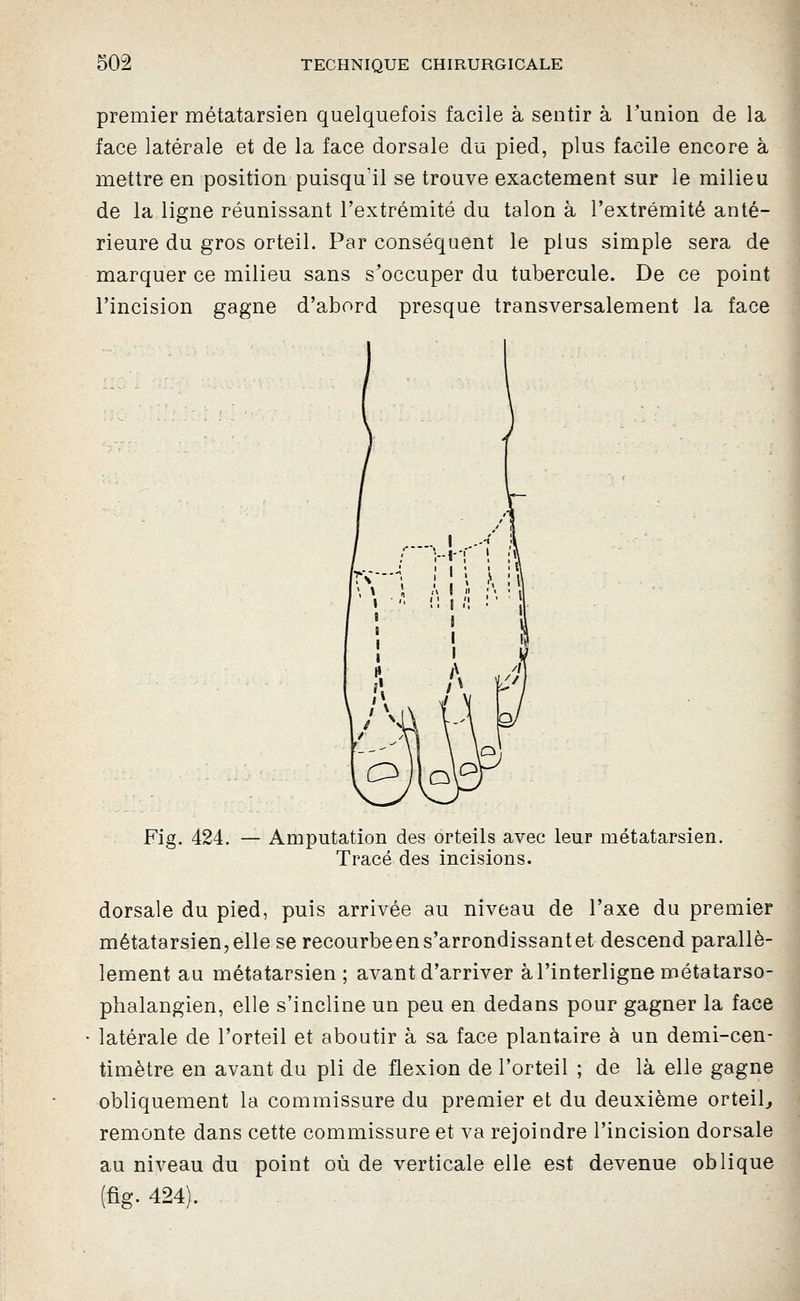 premier métatarsien quelquefois facile à sentir à l'union de la face latérale et de la face dorsale du pied, plus facile encore à mettre en position puisqu'il se trouve exactement sur le milieu de la ligne réunissant l'extrémité du talon à l'extrémité anté- rieure du gros orteil. Par conséquent le plus simple sera de marquer ce milieu sans s'occuper du tubercule. De ce point l'incision gagne d'abord presque transversalement la face I Fig. 424. — Amputation des orteils avec leur métatarsien. Tracé des incisions. dorsale du pied, puis arrivée au niveau de l'axe du premier métatarsien,elle se recourbeens'arrondissantet descend parallè- lement au métatarsien ; avant d'arriver à l'interligne métatarso- phalangien, elle s'incline un peu en dedans pour gagner la face latérale de l'orteil et aboutir à sa face plantaire à un demi-cen- timètre en avant du pli de flexion de l'orteil ; de là elle gagne obliquement la commissure du premier et du deuxième orteil^ remonte dans cette commissure et va rejoindre l'incision dorsale au niveau du point où de verticale elle est devenue oblique (fig. 424). - .