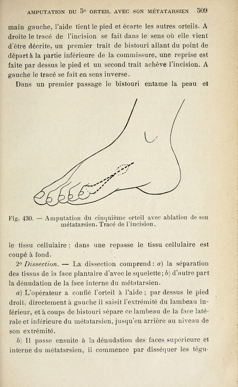 main gauche, l'aide tient le pied et écarte les autres orteils. A droite le tracé de l'incision se fait dans le sens où elle vient d'être décrite, un premier trait de bistouri allant du point de départ à la partie inférieure de la commissure, une reprise est faite par dessus le pied et un second trait achève l'incision. A gauche le tracé se fait en sens inverse. Dans un premier passage le bistouri entame la peau et Fig. 430. — Amputation du cinquième orteil avec ablation de son métatarsien. Tracé de l'incision. le tissu cellulaire ; dans une repasse le tissu cellulaire est coupé à fond. 2^ Dissection. — La dissection comprend: a) la séparation des tissus de la face plantaire d'avec le squelette ; h] d'autre part la dénudation de la face interne du métatarsien. a) L'opérateur a confié l'orteil à l'aide ; par dessus le pied droit, directement à gauche il saisit l'extrémité du lambeau in- férieur, et à coups de bistouri sépare ce lambeau de la face laté- rale et inférieure du métatarsien, jusqu'en arrière au niveau de son extrémité. h] Il passe ensuite à la dénudation des faces supérieure et interne du métatarsien, il commence par disséquer les tégu-