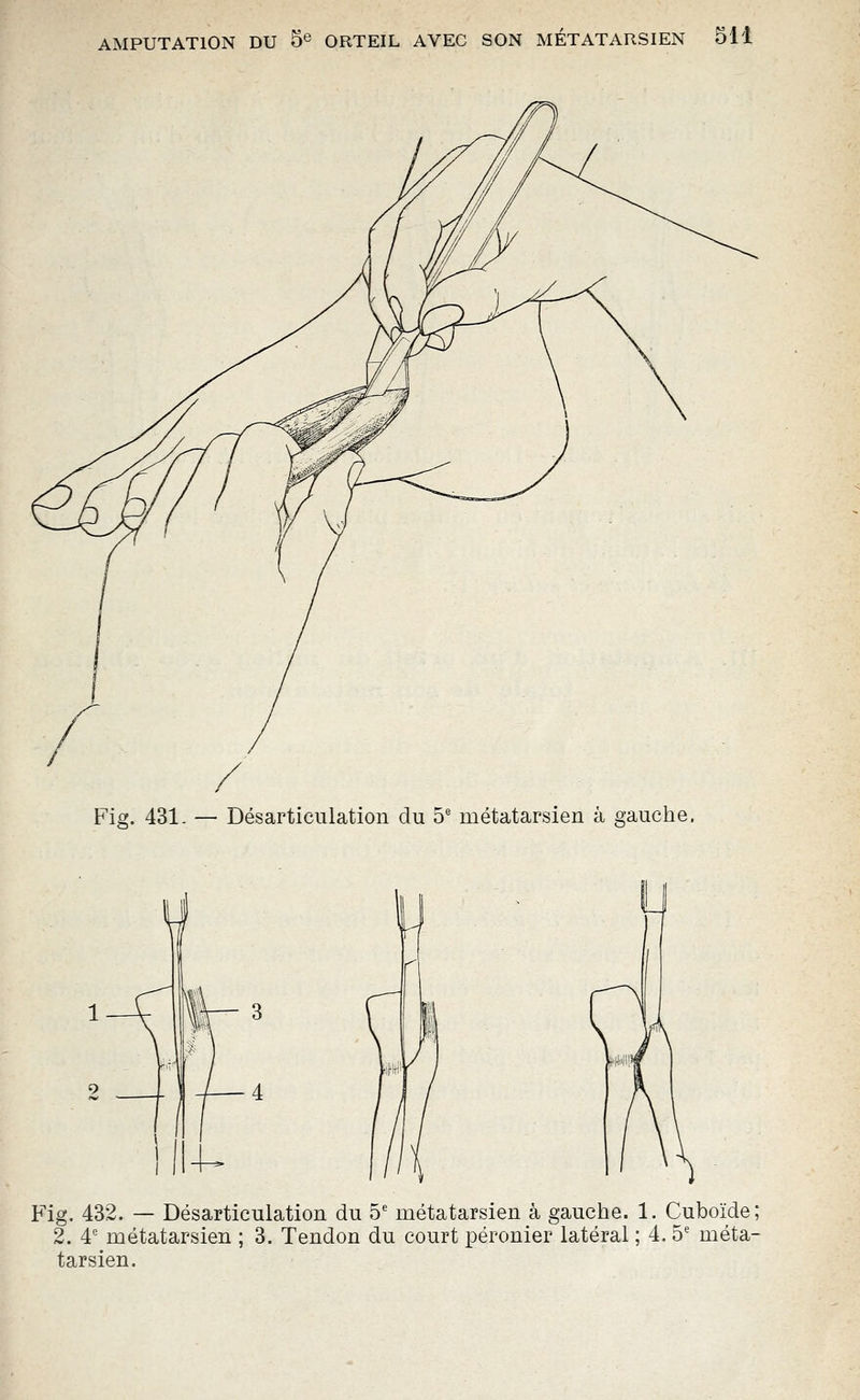 Vi / Fig. 431. — Désarticulation du 5' métatarsien à gauche. Fig. 432. — Désarticulation du 5' métatarsien à gauche. 1. Cuboïde; 2. 4' métatarsien ; 3. Tendon du court péronier latéral ; 4. 5' méta- tarsien.