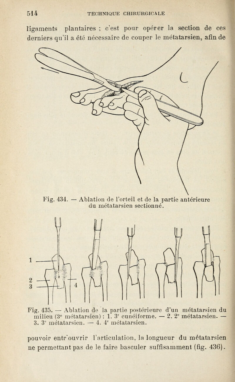ligaments plantaires ; c'est pour opérer la section de ces derniers qu'il a été nécessaire de couper le métatarsien, afin de Fig. 434. — Ablation de l'orteil et de la partie antérieure du métatarsien sectionné. Fig. 435. — Ablation de la partie postérieure d'un métatarsien du milieu (3'' métatarsien) : 1. 3' cunéiforme. — 2. 2' métatarsien. — 3. 3' métatarsien. — 4. 4' métatarsien. pouvoir entr'ouvrir l'articulation, la longueur du métatarsien ne permettant pas de le faire basculer suffisamment (fig. 436).