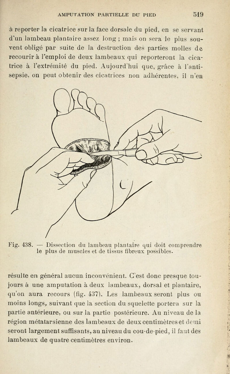 à reporter la cicatrice sur la face dorsale du pied, en se servant d'un lambeau plantaire assez long ; mais on sera le plus sou- vent obligé par suite de la destruction des parties molles de recourir à l'emploi de deux lambeaux qui reporteront la cica- trice à l'extrémité du pied. Aujourd'hui que, grâce à l'anti- sepsie, on peut obtenir des cicatrices non adhérentes, il n'en Fig. 438. — Dissection du lambeau plantaire qui doit comprendre le plus de muscles et de tissus fibreux possibles. résulte en général aucun inconvénient. C'est donc presque tou- jours à une amputation à deux lambeaux, dorsal et plantaire, qu'on aura recours (fig. 437). Les lambeaux seront plus ou moins longs^, suivant que la section du squelette portera sur la partie antérieure, ou sur la partie postérieure. Au niveau de la région métatarsienne des lambeaux de deux centimètres et demi seront largement suffisants, au niveau du cou-de-pied, il faut des lambeaux de quatre centimètres environ.