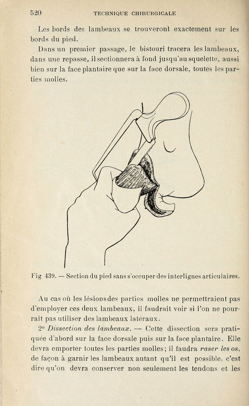 Les bords des lambeaux s© trouveront exactement sur les bords du pied. Dans un premier passage, le bistouri tracera les lambeaux, dans une repasse, il sectionnera à fond jusqu'au squelette, aussi bien sur la face plantaire que sur la face dorsale, toutes les par- ties molles. F'ig 439. — Section du pied sans s'occuper des interlignes articulaires. Au cas où les lésions des parties molles ne permettraient pas d'employer ces deux lambeaux, il faudrait voir si l'on ne pour- rait pas utiliser des lambeaux latéraux. 2^ Dissection des lambeaux. — Cette dissection sera prati- quée d'abord sur la face dorsale puis sur la face plantaire. Elle devra emporter toutes les parties molles ; il faudra raser les os, de façon à garnir les lambeaux autant qu^'il est possible, c'est dire qu'on devra conserver non seulement les tendons et les