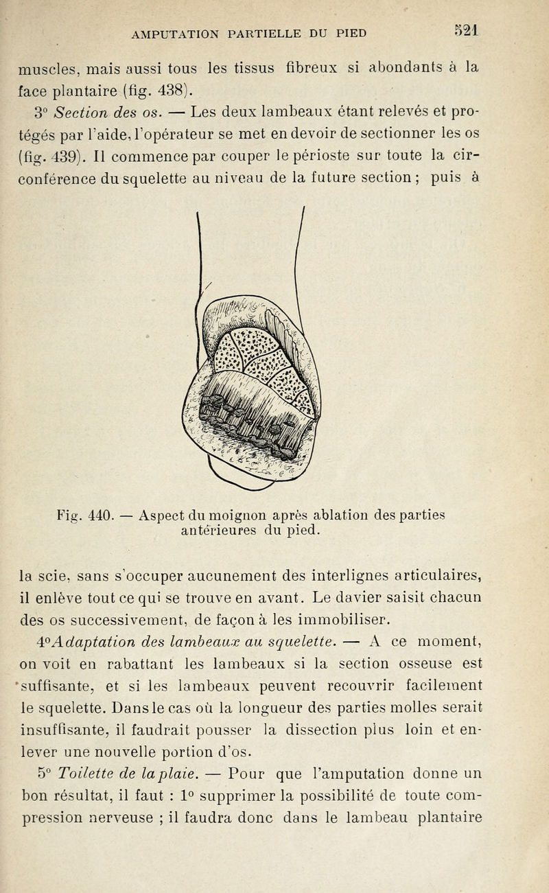 muscles, mais aussi tous les tissus fibreux si abondants à la face plantaire (fig. 438). 3° Section des os. — Les deux lambeaux étant relevés et pro- tégés par l'aide, l'opérateur se met en devoir de sectionner les os (fig. 439). Il commence par couper le périoste sur toute la cir- conférence du squelette au niveau de la future section ; puis à Fig. 440. — Aspect du moignon après ablation des parties antérieures du pied. la scie, sans s'occuper aucunement des interlignes articulaires, il enlève tout ce qui se trouve en avant. Le davier saisit chacun des os successivement, de façon à les immobiliser. 4.^Adaptation des lambeaux au squelette. — A ce moment, on voit en rabattant les lambeaux si la section osseuse est 'suffisante, et si les lambeaux peuvent recouvrir facilement le squelette. Dans le cas où la longueur des parties molles serait insuffisante, il faudrait pousser la dissection plus loin et en- lever une nouvelle portion d'os. 5° Toilette de la plaie. — Pour que l'amputation donne un bon résultat, il faut : 1° supprimer la possibilité de toute com- pression nerveuse ; il faudra donc dans le lambeau plantaire