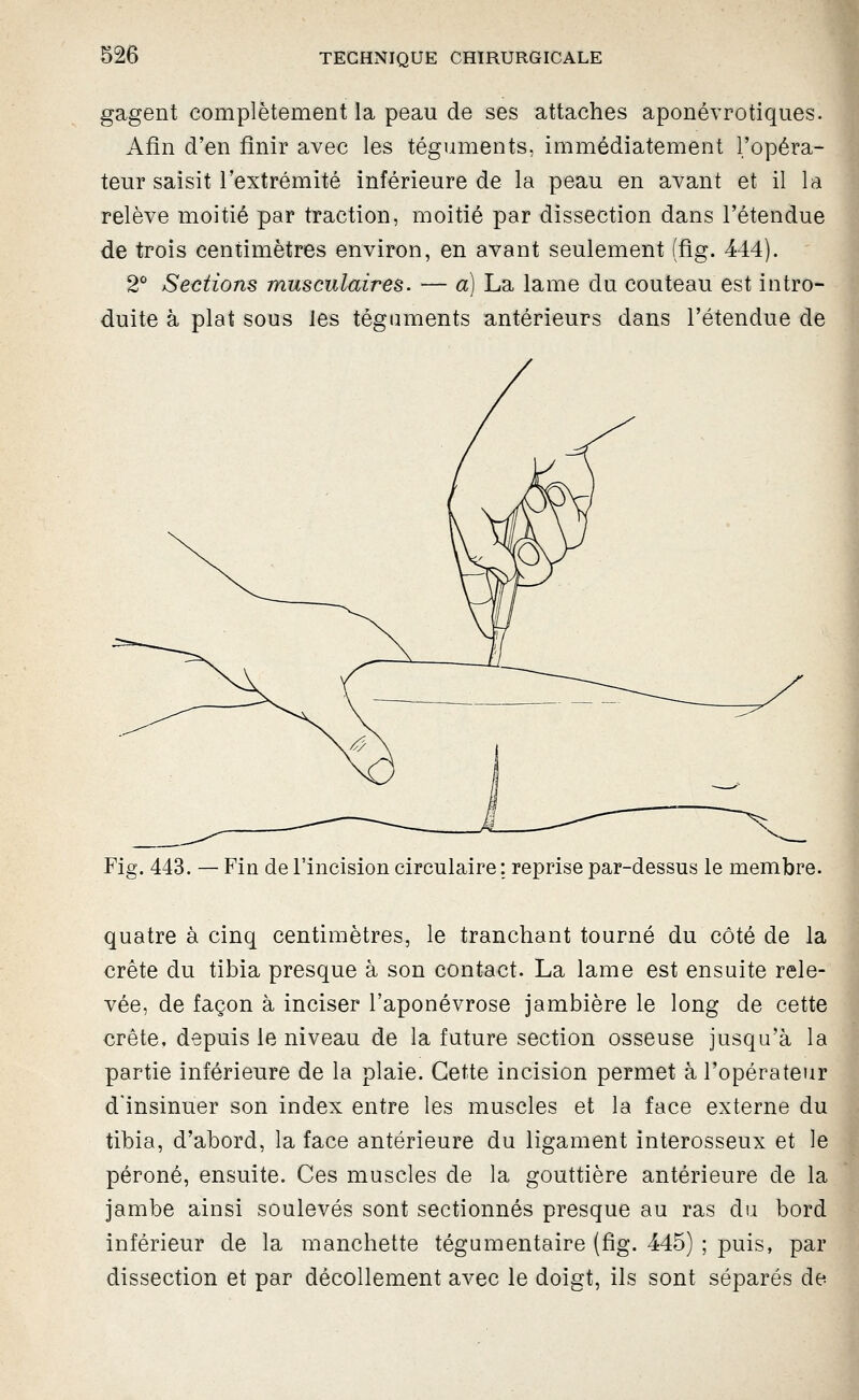 gagent complètement la peau de ses attaches aponévrotiques. Afin d'en finir avec les téguments, immédiatement l'opéra- teur saisit l'extrémité inférieure de la peau en avant et il la relève moitié par traction, moitié par dissection dans l'étendue de trois centimètres environ, en avant seulement (flg. 444). 2 Sections musculaires. — a) La lame du couteau est intro- duite à plat sous les téguments antérieurs dans l'étendue de Fig. 443. — Fin de l'incision circulaire: reprise par-dessus le membre. I quatre à cinq centimètres, le tranchant tourné du côté de la crête du tibia presque à son contact. La lame est ensuite rele- vée, de façon à inciser l'aponévrose jambière le long de cette crête, depuis le niveau de la future section osseuse jusqu'à la partie inférieure de la plaie. Cette incision permet à l'opérateur d'insinuer son index entre les muscles et la face externe du tibia, d'abord, la face antérieure du ligament interosseux et le péroné, ensuite. Ces muscles de la gouttière antérieure de la jambe ainsi soulevés sont sectionnés presque au ras du bord inférieur de la manchette tégumentaire (fig. 445) ; puis, par dissection et par décollement avec le doigt, ils sont séparés de