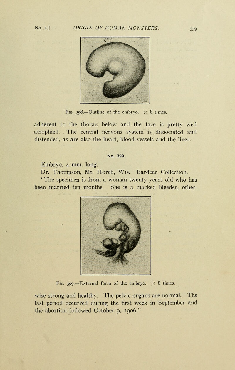 Fig. 398.—Outline of the embryo. X 8 times. adherent to the thorax below and the face is pretty well atrophied. The central nervous system is dissociated and distended, as are also the heart, blood-vessels and the liver. No. 399. Embryo, 4 mm. long. Dr. Thompson, Mt. Horeb, Wis. Bardeen Collection. The specimen is from a woman twenty years old who has been married ten months. She is a marked bleeder, other- Fig. 399.—External form of the embryo. X 8 times. wise strong and healthy. The pelvic organs are normal. The last period occurred during the first week in September and the abortion followed October 9, 1906.