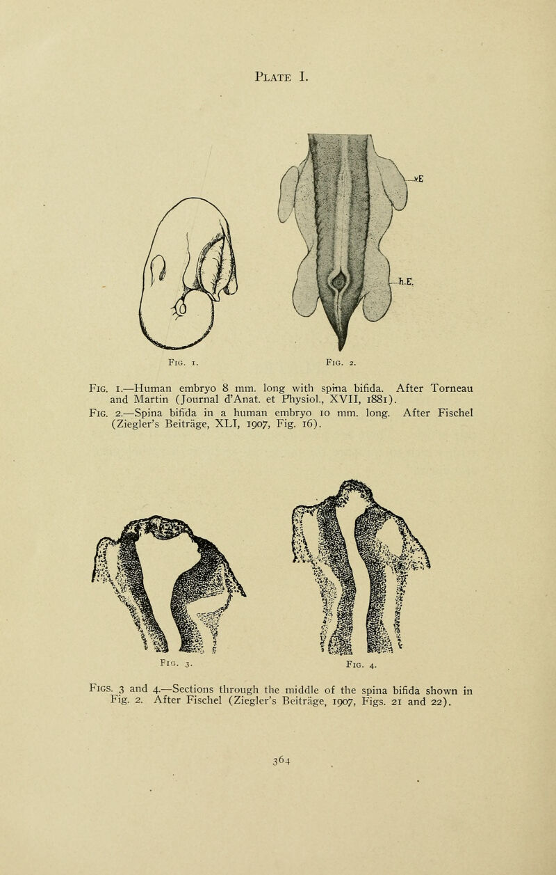 Fig. i. Fig. 2. Fig. i.—Human embryo 8 mm. long with spina bifida. After Torneau and Martin (Journal d'Anat. et Physiol., XVII, 1881). Fig. 2.—Spina bifida in a human embryo 10 mm. long. After Fischel (Ziegler's Beitrage, XLI, 1907, Fig. 16). Fig. 3. Fig. 4. Figs. 3 and 4.—Sections through the middle of the spina bifida shown in Fig. 2. After Fischel (Ziegler's Beitrage, 1907, Figs. 21 and 22).