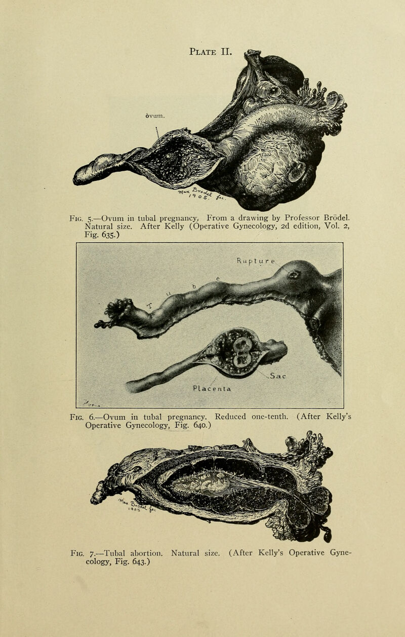 Fig. 5.—Ovum in tubal pregnancy, From a drawing by Professor Brodel. Natural size. After Kelly (Operative Gynecology, 2d edition, Vol. 2, Fig. 635.) Fig. 6.—Ovum in tubal pregnancy. Reduced one-tenth. (After Kelly's Operative Gynecology, Fig. 640.) Fig. 7.—Tubal abortion. Natural size. (After Kelly's Operative Gyne- cology, Fig. 643.)