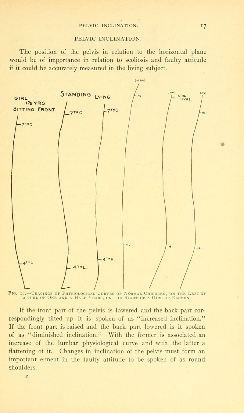 PELVIC INCLINATION. PELVIC INCLINATION. 17 The position of the pelvis in relation to the horizontal plane would be of importance in relation to scoliosis and faulty attitude if it could be accurately measured in the living subject. GIRL l/fi YRS Sitting Front -7THC Standing .7th C .4™l 4th L, Fig. 17.—Tracings op Physiological Curves of Normal Children, on the Left of a Girl of One and a Half Years, on the Right of a Girl of Eleven. If the front part of the pelvis is lowered and the back part cor' respondingly tilted up it is spoken of as increased inclination. If the front part is raised and the back part lowered is it spoken of as diminished inclination. With the former is associated an increase of the lumbar physiological curve and with the latter a flattening of it. Changes in inclination of the pelvis must form an important elment in the faulty attitude to be spoken of as round shoulders.