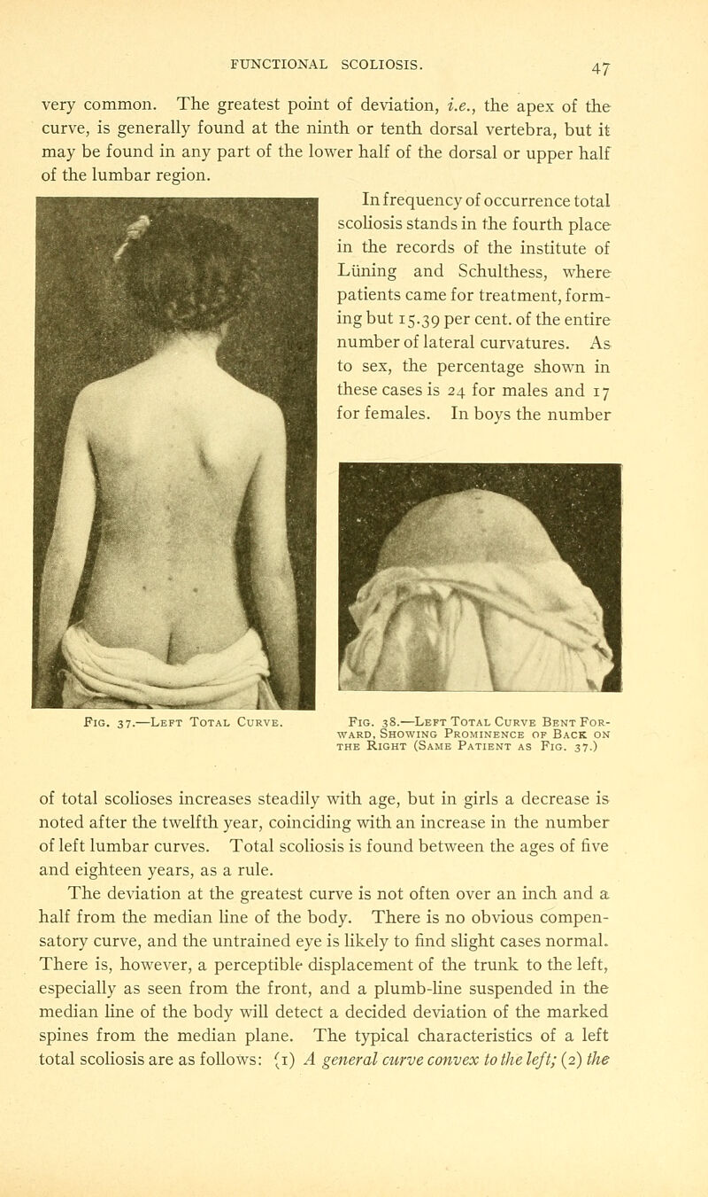 very common. The greatest point of deviation, i.e., the apex of the curve, is generally found at the ninth or tenth dorsal vertebra, but it may be found in any part of the lower half of the dorsal or upper half of the lumbar region. In frequency of occurrence total scoliosis stands in the fourth place in the records of the institute of Liming and Schulthess, where patients came for treatment, form- ing but 15.39 Per cent, of the entire number of lateral curvatures. As to sex, the percentage shown in these cases is 24 for males and 17 for females. In boys the number Fig. 37.—Left Total Curve. Fig. 38.—Left Total Curve Bent For- ward, Showing Prominence of Back on the Right (Same Patient as Fig. 37.) of total scolioses increases steadily with age, but in girls a decrease is noted after the twelfth year, coinciding with an increase in the number of left lumbar curves. Total scoliosis is found between the ages of five and eighteen years, as a rule. The deviation at the greatest curve is not often over an inch and a half from the median line of the body. There is no obvious compen- satory curve, and the untrained eye is likely to find slight cases normal. There is, however, a perceptible displacement of the trunk to the left, especially as seen from the front, and a plumb-line suspended in the median line of the body will detect a decided deviation of the marked spines from the median plane. The typical characteristics of a left total scoliosis are as follows: (1) A general curve convex to the left; (2) the