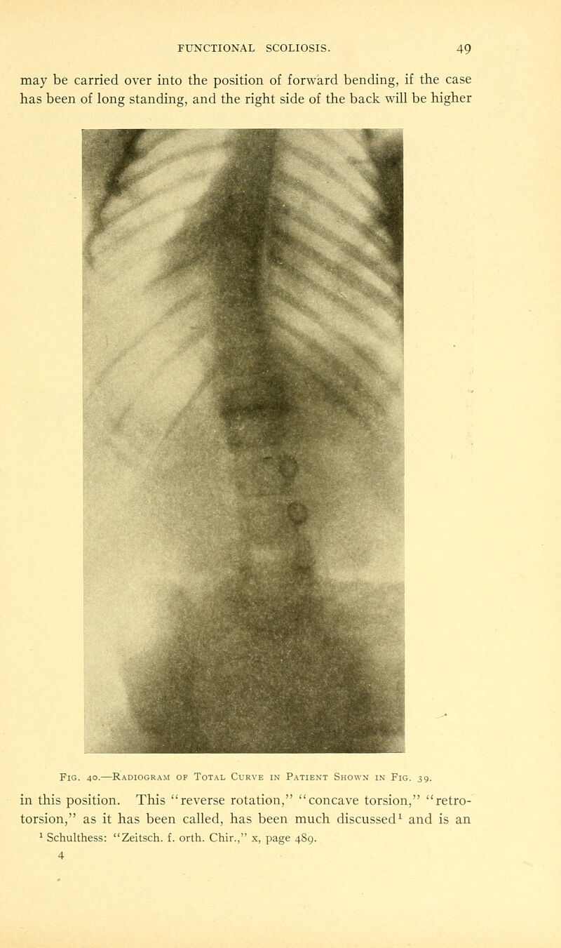 may be carried over into the position of forward bending, if the case has been of long standing, and the right side of the back will be higher Fig. 40.—Radiogram op Total Curve in Patient Shown in Fig. 39. in this position. This reverse rotation, concave torsion, retro- torsion, as it has been called, has been much discussed1 and is an 1 Schulthess: Zeitsch. f. orth. Chir., x, page 489.
