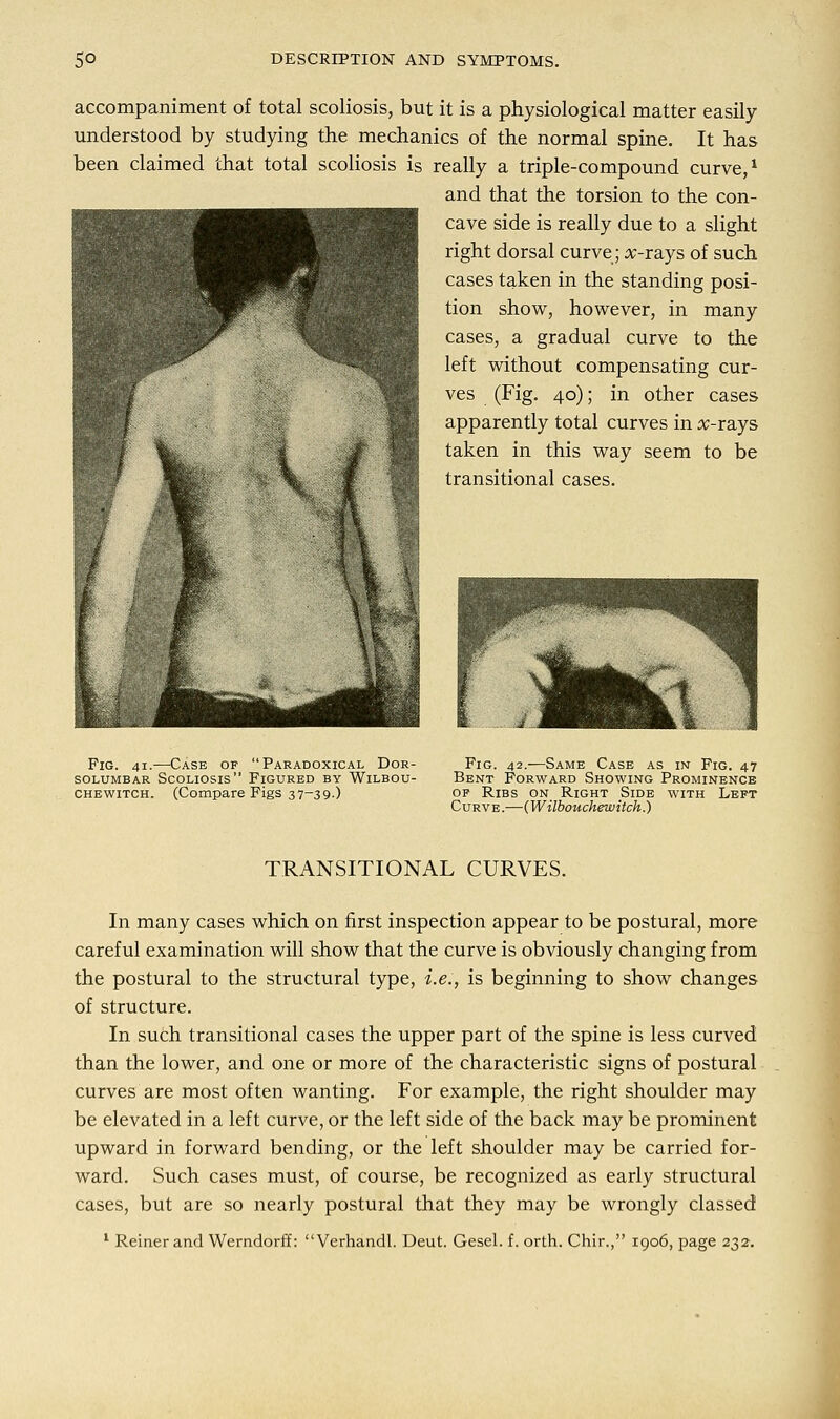 accompaniment of total scoliosis, but it is a physiological matter easily understood by studying the mechanics of the normal spine. It has been claimed that total scoliosis is really a triple-compound curve,1 and that the torsion to the con- cave side is really due to a slight right dorsal curve; x-rays of such cases taken in the standing posi- tion show, however, in many cases, a gradual curve to the left without compensating cur- ves (Fig. 40); in other cases apparently total curves in x-rays taken in this way seem to be transitional cases. Fig. 41.-—Case of Paradoxical Dor- solumbar Scoliosis Figured by Wilbou- Chewitch. (Compare Figs 37-39.) Fig. 42.—Same Case as in Fig. 47 Bent Forward Showing Prominence op Ribs on Right Side with Left Curve.—(Wilbouchewitch.) TRANSITIONAL CURVES. In many cases which on first inspection appear to be postural, more careful examination will show that the curve is obviously changing from the postural to the structural type, i.e., is beginning to show changes of structure. In such transitional cases the upper part of the spine is less curved than the lower, and one or more of the characteristic signs of postural curves are most often wanting. For example, the right shoulder may be elevated in a left curve, or the left side of the back may be prominent upward in forward bending, or the left shoulder may be carried for- ward. Such cases must, of course, be recognized as early structural cases, but are so nearly postural that they may be wrongly classed