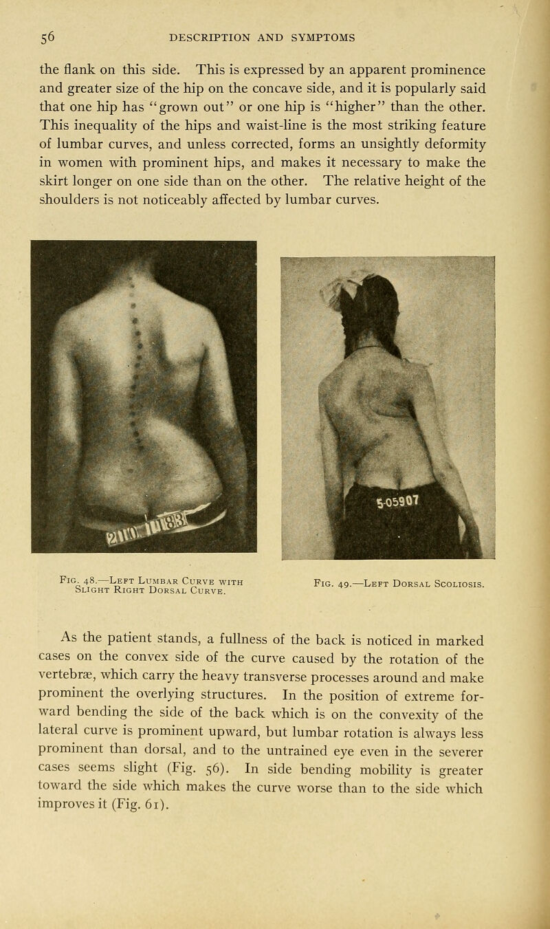 the flank on this side. This is expressed by an apparent prominence and greater size of the hip on the concave side, and it is popularly said that one hip has grown out or one hip is higher than the other. This inequality of the hips and waist-line is the most striking feature of lumbar curves, and unless corrected, forms an unsightly deformity in women with prominent hips, and makes it necessary to make the skirt longer on one side than on the other. The relative height of the shoulders is not noticeably affected by lumbar curves. 505907 Fig. 48.—Left Lumbar Curve with Slight Right Dorsal Curve. Fig. 49.—Left Dorsal Scoliosis. As the patient stands, a fullness of the back is noticed in marked cases on the convex side of the curve caused by the rotation of the vertebrae, which carry the heavy transverse processes around and make prominent the overlying structures. In the position of extreme for- ward bending the side of the back which is on the convexity of the lateral curve is prominent upward, but lumbar rotation is always less prominent than dorsal, and to the untrained eye even in the severer cases seems slight (Fig. 56). In side bending mobility is greater toward the side which makes the curve worse than to the side which improves it (Fig. 61).