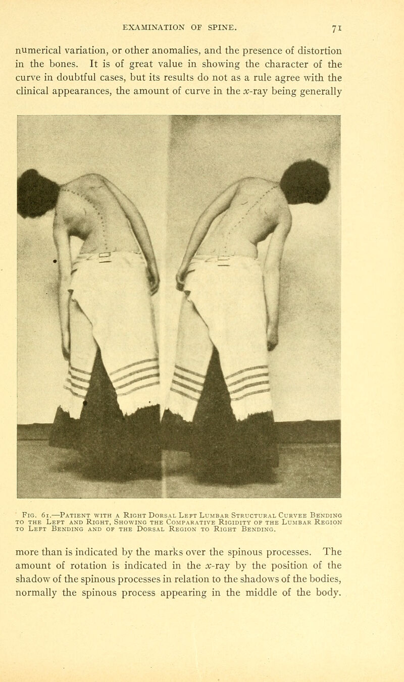 numerical variation, or other anomalies, and the presence of distortion in the bones. It is of great value in showing the character of the curve in doubtful cases, but its results do not as a rule agree with the clinical appearances, the amount of curve in the #-ray being generally Fig. 61.—Patient with a Right Dorsal Left Lumbar Structural Curvee Bending to the Left and Right, Showing the Comparative Rigidity of the Lumbar Region to Left Bending and of the Dorsal Region to Right Bending. more than is indicated by the marks over the spinous processes. The amount of rotation is indicated in the #-ray by the position of the shadow of the spinous processes in relation to the shadows of the bodies, normally the spinous process appearing in the middle of the body.