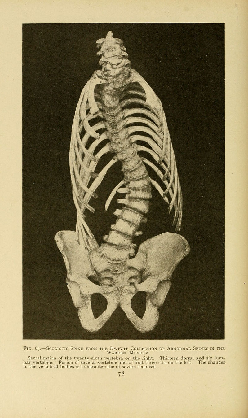Fig. 65.—Scoliotic Spine from the Dwight Collection op Abnormal Spines in the Warren Museum. Sacralization of the twenty-sixth vertebra on the right. Thirteen dorsal and six lum- bar vertebrae. Fusion of several vertebras and of first three ribs on the left. The changes in the vertebral bodies are characteristic of severe scoliosis.