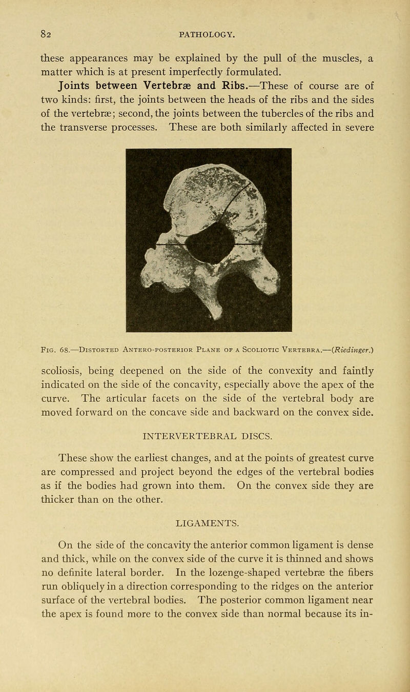 these appearances may be explained by the pull of the muscles, a matter which is at present imperfectly formulated. Joints between Vertebrae and Ribs.—These of course are of two kinds: first, the joints between the heads of the ribs and the sides of the vertebrae; second, the joints between the tubercles of the ribs and the transverse processes. These are both similarly affected in severe Fig. 68.—Distorted Anteroposterior Plane of a Scoliotic Vertebra.—(Riedinger.) scoliosis, being deepened on the side of the convexity and faintly indicated on the side of the concavity, especially above the apex of the curve. The articular facets on the side of the vertebral body are moved forward on the concave side and backward on the convex side. INTERVERTEBRAL DISCS. These show the earliest changes, and at the points of greatest curve are compressed and project beyond the edges of the vertebral bodies as if the bodies had grown into them. On the convex side they are thicker than on the other. LIGAMENTS. On the side of the concavity the anterior common ligament is dense and thick, while on the convex side of the curve it is thinned and shows no definite lateral border. In the lozenge-shaped vertebrae the fibers run obliquely in a direction corresponding to the ridges on the anterior surface of the vertebral bodies. The posterior common ligament near the apex is found more to the convex side than normal because its in-
