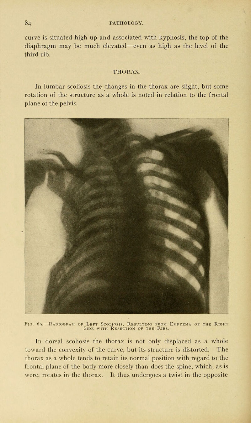 curve is situated high up and associated with kyphosis, the top of the diaphragm may be much elevated—even as high as the level of the third rib. THORAX. In lumbar scoliosis the changes in the thorax are slight, but some rotation of the structure as a whole is noted in relation to the frontal plane of the pelvis. Pig. 69.—Radiogram of Left Scoliosis, Resulting from Empyema of the Right Side with Resection of the Ribs. In dorsal scoliosis the thorax is not only displaced as a whole toward the convexity of the curve, but its structure is distorted. The thorax as a whole tends to retain its normal position with regard to the frontal plane of the body more closely than does the spine, which, as is were, rotates in the thorax. It thus undergoes a twist in the opposite