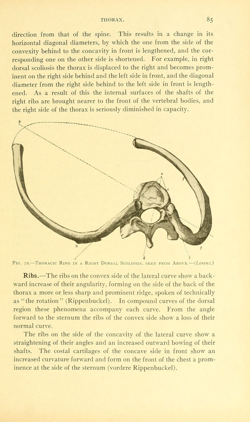 direction from that of the spine. This results in a change in its horizontal diagonal diameters, by which the one from the side of the convexity behind to the concavity in front is lengthened, and the cor- responding one on the other side is shortened. For example, in right dorsal scoliosis the thorax is displaced to the right and becomes prom- inent on the right side behind and the left side in front, and the diagonal diameter from the right side behind to the left side in front is length- ened. As a result of this the internal surfaces of the shafts of the right ribs are brought nearer to the front of the vertebral bodies, and the right side of the thorax is seriously diminished in capacity. Fig. 70.—Thoracic Ring in a Right Dorsal Scoliosis, seen from Above.—(Lorevz.) Ribs.—The ribs on the convex side of the lateral curve show a back- ward increase of their angularity, forming on the side of the back of the thorax a more or less sharp and prominent ridge, spoken of technically as the rotation (Rippenbuckel). In compound curves of the dorsal region these phenomena accompany each curve. From the angle forward to the sternum the ribs of the convex side show a loss of their normal curve. The ribs on the side of the concavity of the lateral curve show a straightening of their angles and an increased outward bowing of their shafts. The costal cartilages of the concave side in front show an increased curvature forward and form on the front of the chest a prom- inence at the side of the sternum (vordere Rippenbuckel).
