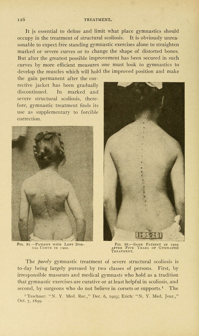 It is essential to define and limit what place gymnastics should occupy in the treatment of structural scoliosis. It is obviously unrea- sonable to expect free standing gymnastic exercises alone to straighten marked or severe curves or to change the shape of distorted bones. But after the greatest possible improvement has been secured in such curves by more efficient measures one must look to gymnastics to develop the muscles which will hold the improved position and make the gain permanent after the cor- rective jacket has been gradually discontinued. In marked and severe structural scoliosis, there- fore, gymnastic treatment finds its use as supplementary to forcible correction. Fig. 87.—Patient with Left Dor- sal Curve in 1900. Fig. 88.—Same Patient in 1905 after Five Years of Gymnastic Treatment. The purely gymnastic treatment of severe structural scoliosis is to-day being largely pursued by two classes of persons. First, by irresponsible masseurs and medical gymnasts who hold as a tradition that gymnastic exercises are curative or at least helpful in scoliosis, and second, by surgeons who do not believe in corsets or supports.1 The 1 Teschner: N. Y. Med. Rec, Dec. 6, 1903; Erich: N. Y. Med. Jour., Oct. 7, 1899.