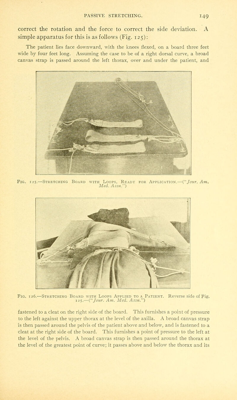 A correct the rotation and the force to correct the side deviation, simple apparatus for this is as follows (Fig. 125): The patient lies face downward, with the knees flexed, on a board three feet wide by four feet long. Assuming the case to be of a right dorsal curve, a broad canvas strap is passed around the left thorax, over and under the patient, and Fig. 125.—Stretching Board with Loops, Ready for Application.—{Jour. Am. Med. Assn.) Fig. 126.—Stretching Board with Loops Applied to a Patient. 125.—(Jour. Am. Med. Assn.) Reverse side of Fig. fastened to a cleat on the right side of the board. This furnishes a point of pressure to the left against the upper thorax at the level of the axilla. A broad canvas strap is then passed around the pelvis of the patient above and below, and is fastened to a cleat at the right side of the board. This furnishes a point of pressure to the left at the level of the pelvis. A broad canvas strap is then passed around the thorax at the level of the greatest point of curve; it passes above and below the thorax and its