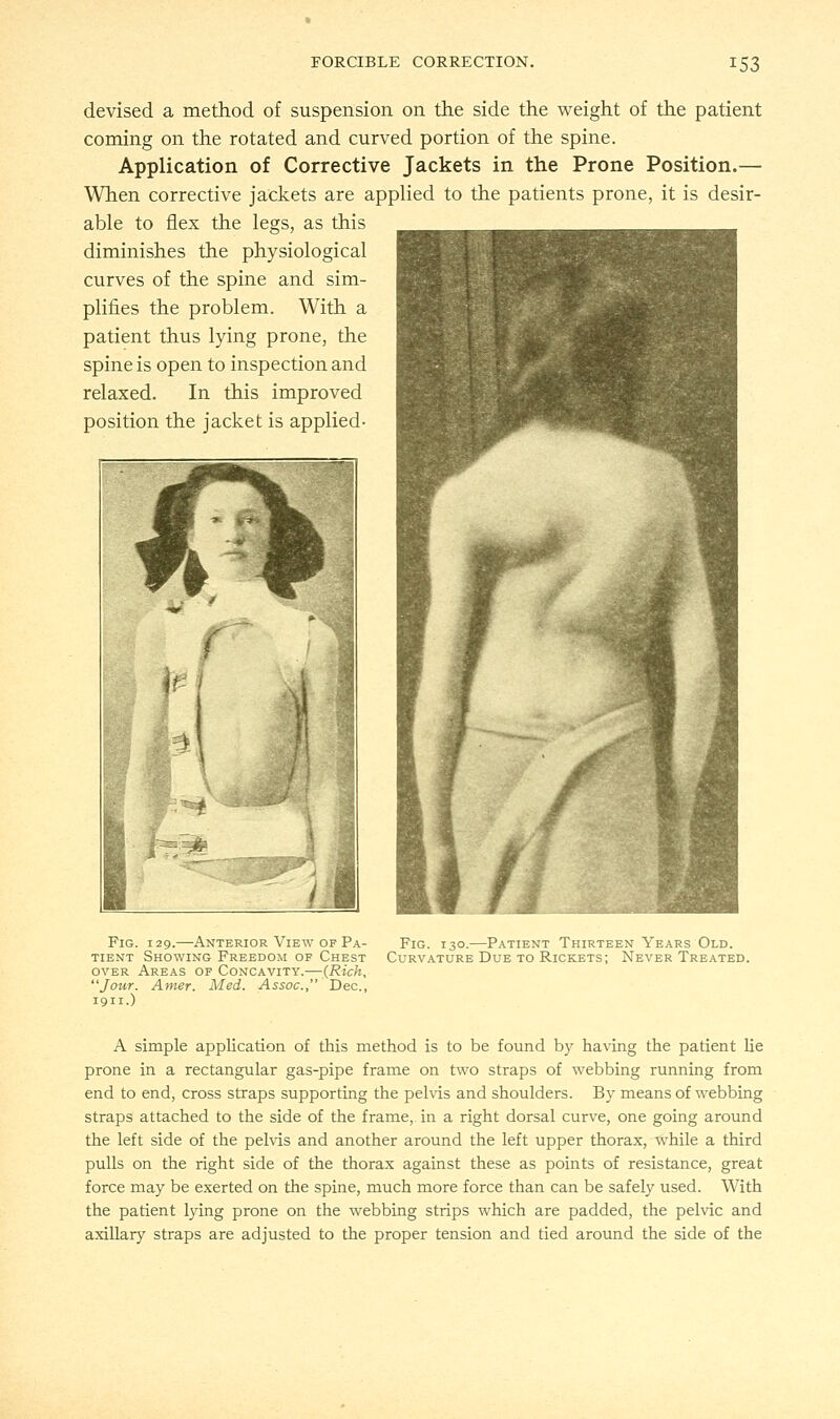 devised a method of suspension on the side the weight of the patient coming on the rotated and curved portion of the spine. Application of Corrective Jackets in the Prone Position.— When corrective jackets are applied to the patients prone, it is desir- able to flex the legs, as this diminishes the physiological curves of the spine and sim- plifies the problem. With a patient thus lying prone, the spine is open to inspection and relaxed. In this improved position the jacket is applied- Fig. 129.—Anterior View of Pa- tient Showing Freedom of Chest over Areas of Concavity.—(Rich, Jour. Amer. Med. Assoc, Dec, 1911.) Fig. 130.—Patient Thirteen Years Old. Curvature Due to Rickets; Never Treated. A simple application of this method is to be found by having the patient lie prone in a rectangular gas-pipe frame on two straps of webbing running from end to end, cross straps supporting the pelvis and shoulders. By means of webbing straps attached to the side of the frame, in a right dorsal curve, one going around the left side of the pelvis and another around the left upper thorax, while a third pulls on the right side of the thorax against these as points of resistance, great force may be exerted on the spine, much more force than can be safely used. With the patient lying prone on the webbing strips which are padded, the pelvic and axillary straps are adjusted to the proper tension and tied around the side of the
