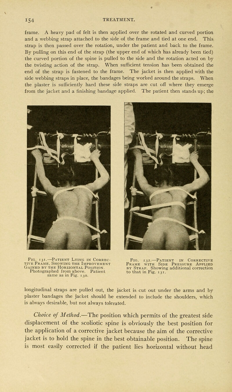 frame. A heavy pad of felt is then applied over the rotated and curved portion and a webbing strap attached to the side of the frame and tied at one end. This strap is then passed over the rotation, under the patient and back to the frame. By pulling on this end of the strap (the upper end of which has already been tied) the curved portion of the spine is pulled to the side and the rotation acted on by the twisting action of the strap. When sufficient tension has been obtained the end of the strap is fastened to the frame. The jacket is then applied with the side webbing straps in place, the bandages being worked around the straps. When the plaster is sufficiently hard these side straps are cut off where they emerge from the jacket and a finishing bandage applied. The patient then stands up; the Fig. 131.—Patient Lying in Correc- tive Frame, Showing the Improvement Gained by the Horizontal Position. Photographed from above. Patient same as in Fig. 130. Fig. 132.—Patient in Corrective Frame with Side Pressure Applied by Strap. Showing additional correction to that in Fig. 131. longitudinal straps are pulled out, the jacket is cut out under the arms and by plaster bandages the jacket should be extended to include the shoulders, which is always desirable, but not always tolerated. Choice of Method.—The position which permits of the greatest side displacement of the scoliotic spine is obviously the best position for the application of a corrective jacket because the aim of the corrective jacket is to hold the spine in the best obtainable position. The spine is most easily corrected if the patient lies horizontal without head