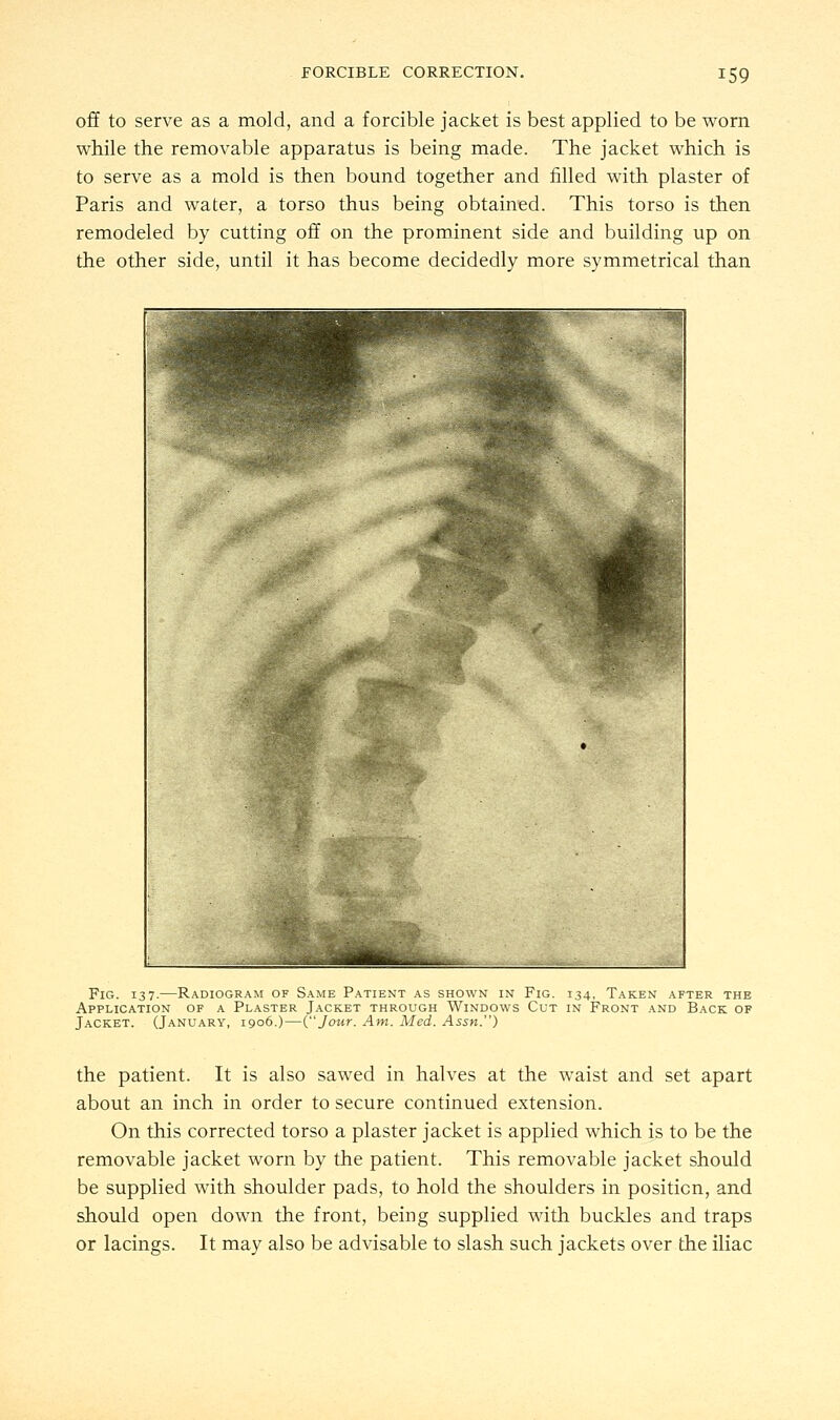 off to serve as a mold, and a forcible jacket is best applied to be worn while the removable apparatus is being made. The jacket which is to serve as a mold is then bound together and filled with plaster of Paris and water, a torso thus being obtained. This torso is then remodeled by cutting off on the prominent side and building up on the other side, until it has become decidedly more symmetrical than Fig. 137.—Radiogram of Same Patient as shown in Fig. 134, Taken after the Application of a Plaster Jacket through Windows Cut in Front and Back of Jacket. (January, 1906.)—{Jour. Am. Med. Assn.) the patient. It is also sawed in halves at the waist and set apart about an inch in order to secure continued extension. On this corrected torso a plaster jacket is applied which is to be the removable jacket worn by the patient. This removable jacket should be supplied with shoulder pads, to hold the shoulders in position, and should open down the front, being supplied with buckles and traps or lacings. It may also be advisable to slash such jackets over the iliac