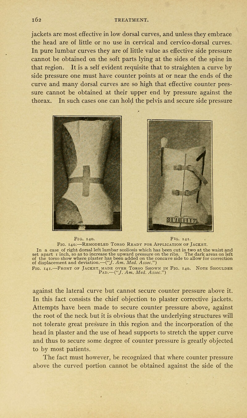 jackets are most effective in low dorsal curves, and unless they embrace the head are of little or no use in cervical and cervico-dorsal curves. In pure lumbar curves they are of little value as effective side pressure cannot be obtained on the soft parts lying at the sides of the spine in that region. It is a self evident requisite that to straighten a curve by side pressure one must have counter points at or near the ends of the curve and many dorsal curves are so high that effective counter pres- sure cannot be obtained at their upper end by pressure against the thorax. In such cases one can hold the pelvis and secure side pressure Fig. 140. Fig. 141. Fig. 140;—Remodeled Torso Ready for Application of Jacket. In a case of right dorsal left lumbar scoliosis which has been cut in two at the waist and set apart 1 inch, so as to increase the upward pressure on the ribs. The dark areas on left of the torso show where plaster has been added on the concave side to allow for correction of displacement and deviation.—(/• Am. Med. Assoc) Fig. 141.—Front of Jacket, made over Torso Shown in Fig. 140. Note Shoulder Pad.—(J. Am. Med. Assoc) against the lateral curve but cannot secure counter pressure above it. In this fact consists the chief objection to plaster corrective jackets. Attempts have been made to secure counter pressure above, against the root of the neck but it is obvious that the underlying structures will not tolerate great pressure in this region and the incorporation of the head in plaster and the use of head supports to stretch the upper curve and thus to secure some degree of counter pressure is greatly objected to by most patients. The fact must however, be recognized that where counter pressure above the curved portion cannot be obtained against the side of the