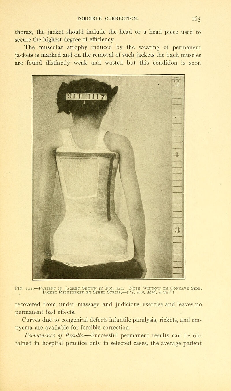 thorax, the jacket should include the head or a head piece used to secure the highest degree of efficiency. The muscular atrophy induced by the wearing of permanent jackets is marked and on the removal of such jackets the back muscles are found distinctly weak and wasted but this condition is soon Fig. 142.—Patient in Jacket Shown in Fig. 141. Note Window on Concave Side. Jacket Reinforced by Steel Strips.—(/• Am. Med. Assn.) recovered from under massage and judicious exercise and leaves no permanent bad effects. Curves due to congenital defects infantile paralysis, rickets, and em- pyema are available for forcible correction. Permanence of Results.—Successful permanent results can be ob- tained in hospital practice only in selected cases, the average patient