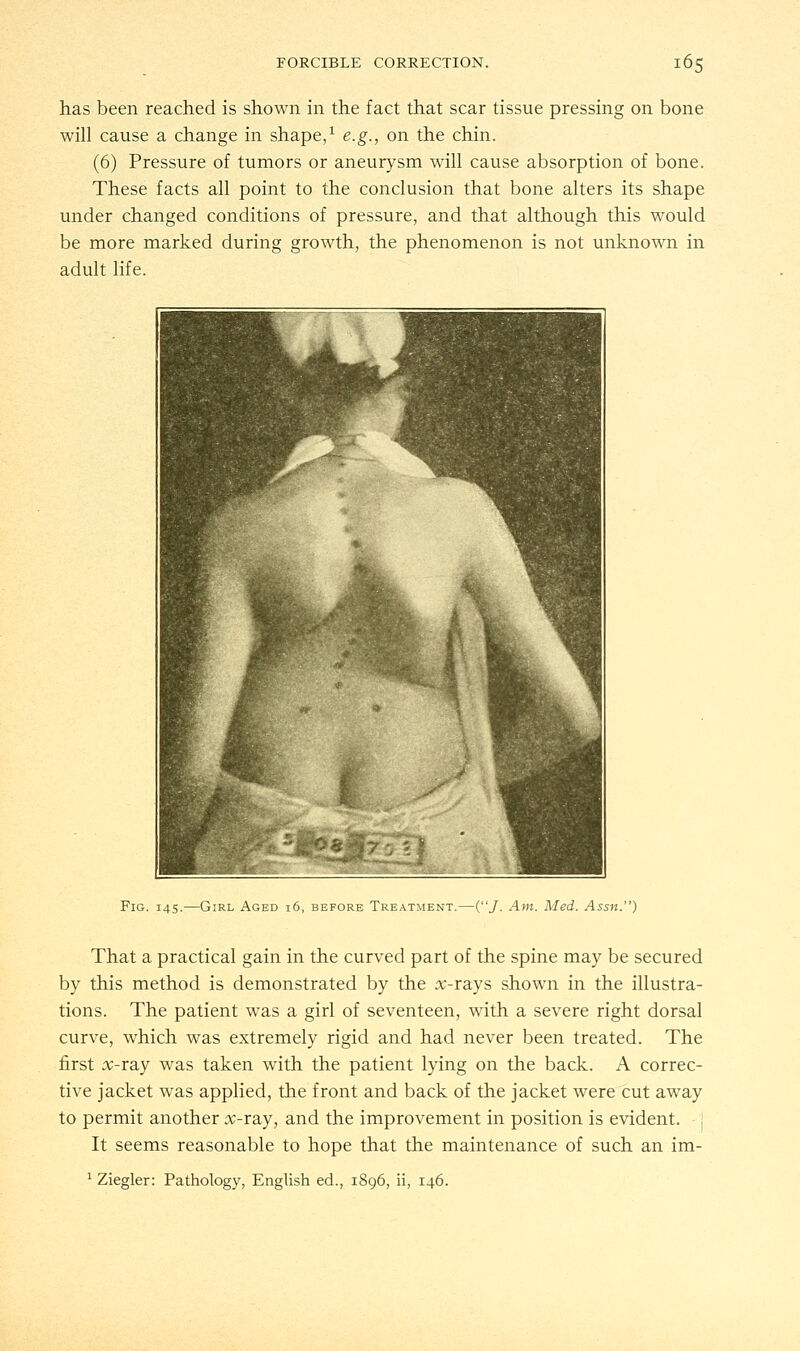 has been reached is shown in the fact that scar tissue pressing on bone will cause a change in shape,1 e.g., on the chin. (6) Pressure of tumors or aneurysm will cause absorption of bone. These facts all point to the conclusion that bone alters its shape under changed conditions of pressure, and that although this would be more marked during growth, the phenomenon is not unknown in adult life. Fig. 145.—Girl Aged 16, before Treatment.—(/• Am. Med. Assn.) That a practical gain in the curved part of the spine may be secured by this method is demonstrated by the x-rays shown in the illustra- tions. The patient was a girl of seventeen, with a severe right dorsal curve, which was extremely rigid and had never been treated. The first x-ray was taken with the patient lying on the back. A correc- tive jacket was applied, the front and back of the jacket were cut away to permit another x-ray, and the improvement in position is evident. It seems reasonable to hope that the maintenance of such an im- 1 Ziegler: Pathology, English ed., 1896, ii, 146.