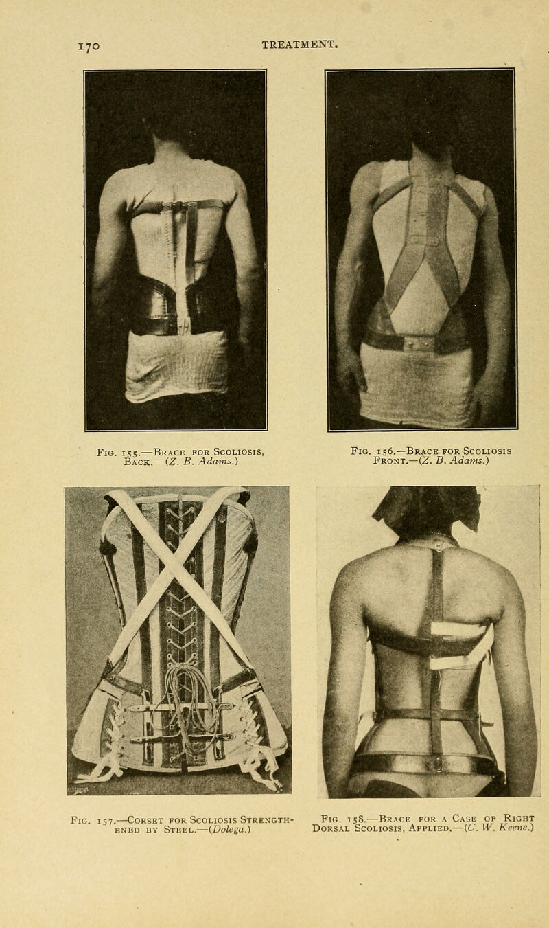 Fig. 155.-—Brace for Scoliosis, Back.—(Z. B. Adams.) Fig. 156.—Brace for Scoliosis Front.—(Z. B. Adams.) Fig. 157.—Corset for Scoliosis Strength- ened by Steel.—{Dolega.) Fig. 158.—Brace for a Case of Right Dorsal Scoliosis, Applied.—(C. W. Keene.)