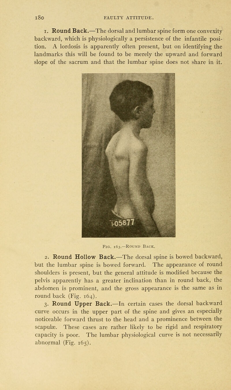 i. Round Back.—The dorsal and lumbar spine form one convexity backward, which is physiologically a persistence of the infantile posi- tion. A lordosis is apparently often present, but on identifying the landmarks this will be found to be merely the upward and forward slope of the sacrum and that the lumbar spine does not share in it. Fig. 163.—Round Back. 2. Round Hollow Back.—The dorsal spine is bowed backward, but the lumbar spine is bowed forward. The appearance of round shoulders is present, but the general attitude is modified because the pelvis apparently has a greater inclination than in round back, the abdomen is prominent, and the gross appearance is the same as in round back (Fig. 164). 3. Round Upper Back.—In certain cases the dorsal backward curve occurs in the upper part of the spine and gives an especially noticeable forward thrust to the head and a prominence between the scapulae. These cases are rather likely to be rigid and respiratory capacity is poor. The lumbar physiological curve is not necessarily abnormal (Fig. 165).