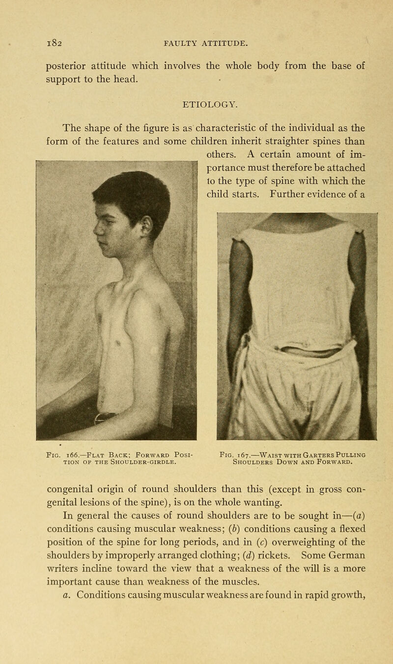 posterior attitude which involves the whole body from the base of support to the head. ETIOLOGY. The shape of the figure is as characteristic of the individual as the form of the features and some children inherit straighter spines than others. A certain amount of im- ' portance must therefore be attached lo the type of spine with which the child starts. Further evidence of a Fig. 166.—Flat Back; Forward Posi- tion of the Shoulder-girdle. Fig. 167.—Waist with Garters Pulling Shoulders Down and Forward. congenital origin of round shoulders than this (except in gross con- genital lesions of the spine), is on the whole wanting. In general the causes of round shoulders are to be sought in—(a) conditions causing muscular weakness; (b) conditions causing a flexed position of the spine for long periods, and in (c) overweighting of the shoulders by improperly arranged clothing; (d) rickets. Some German writers incline toward the view that a weakness of the will is a more important cause than weakness of the muscles. a. Conditions causing muscular weakness are found in rapid growth,