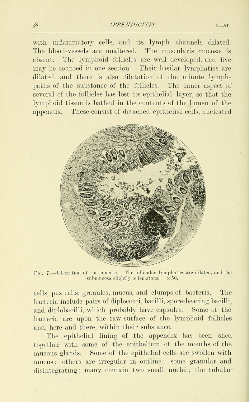 with inflammatory cells, and its lymph channels dilated. The blood-vessels are unaltered. The muscularis mucosa? is absent. The lymphoid follicles are well developed, and five may be counted in one section. Their basilar lymphatics are dilated, and there is also dilatation of the minute lymph- paths of the substance of the follicles. The inner aspect of several of the follicles has lost its epithelial layer, so that the lymphoid tissue is bathed in the contents of the lumen of the appendix. These consist of detached epithelial cells, nucleated -Ulceration of the mucosa. The follicular lymphatics are dilated, and the submucosa slightly oedematous. x 50. cells, pus cells, granules, mucus, and clumps of bacteria. The bacteria include pairs of diplococci, bacilli, spore-bearing bacilli, and diplobacilli, which probably have capsules. Some of the bacteria are upon the raw surface of the lymphoid follicles and, here and there, within their substance. The epithelial lining of the appendix has been shed together with some of the epithelium of the mouths of the mucous glands. Some of the epithelial cells are swollen with mucus; others are irregular in outline; some granular and disintegrating; many contain two small nuclei; the tubular