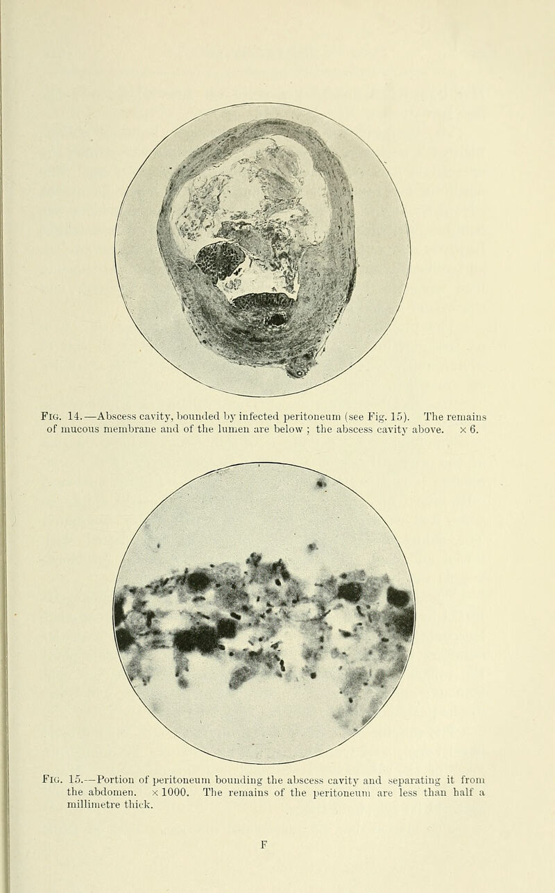 Fig. 14.—-Abscess cavity, bounded by infected peritoneum (see Fig. 15). The remains of mucous membrane and of the lumen are below ; the abscess cavity above, x 6. Fig. 15.—Portion of peritoneum bounding the abscess cavity and separating it from the abdomen. x 1000. The remains of the peritoneum are less than half a millimetre thick.