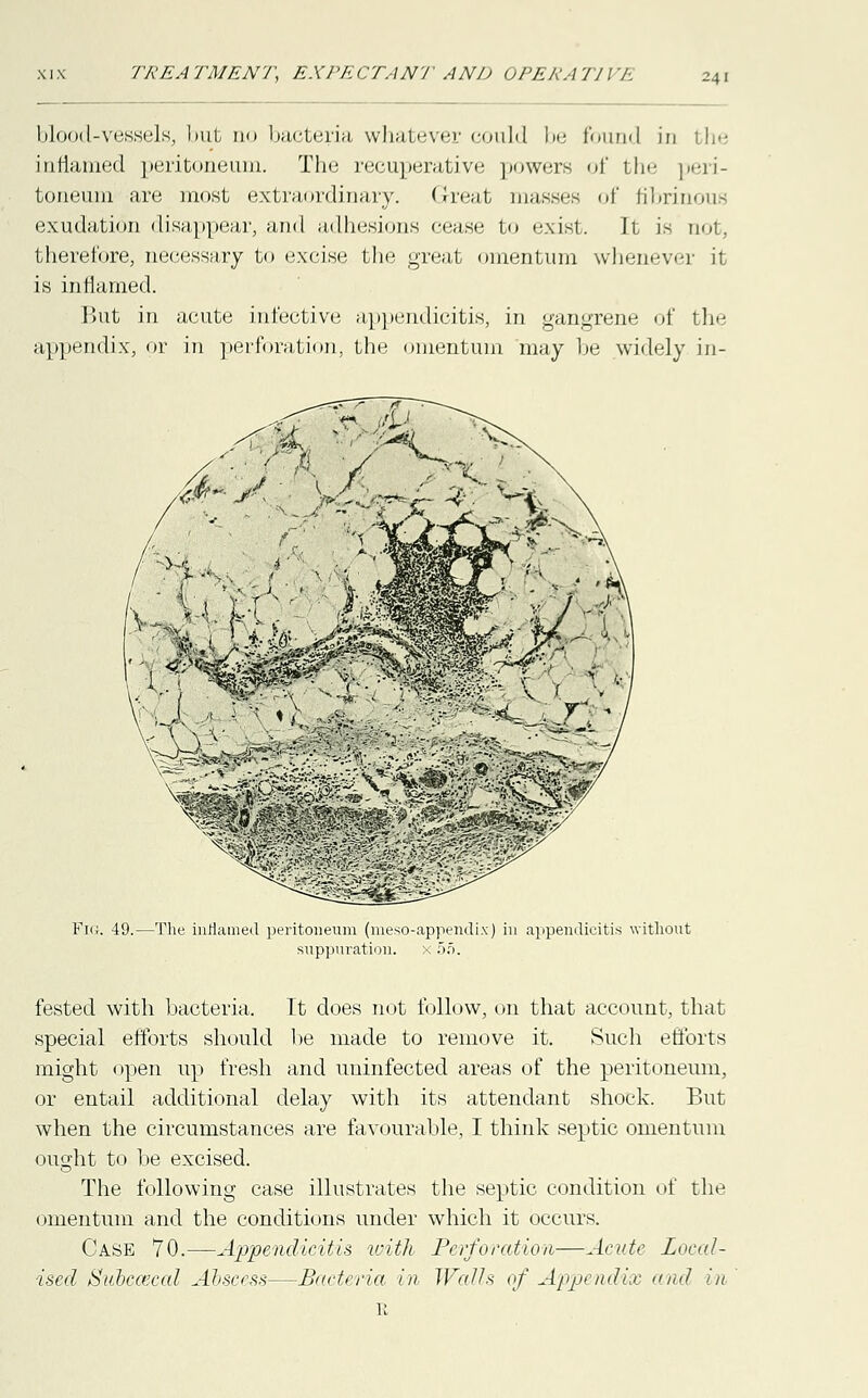 24] blood-vessels, but no bacteria whatever could be found in the inflamed peritoneum. The recuperative powers of the peri- toneum are most extraordinary. Great manses of fibrinous exudation disappear, and adhesions cease to exist. k ia not, therefore, necessary to excise the great omentum whenever it is inflamed. P>ut in acute infective appendicitis, in gangrene of the appendix, or in perforation, the omentum may be widely in- Fn;. 49.—The inflamed peritoneum (meso-appendix) in appendicitis without suppuration. x 5o. fested with bacteria. It does not follow, on that account, that special efforts should he made to remove it. Such efforts might open up fresh and uninfected areas of the peritoneum, or entail additional delay with its attendant shock. But when the circumstances are favourable, I think septic omentum ought to be excised. The following case illustrates the septic condition of the omentum and the conditions under which it occurs. Case 70.—Appendicitis with Perforation—Acute Local- ised Subcascal Abscess—Bacteria in Walls of Appendix and in E