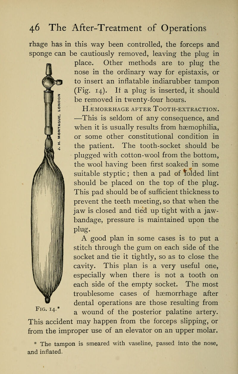 rhage has in this way been controlled, the forceps and sponge can be cautiously removed, leaving the plug in place. Other methods are to plug the nose in the ordinary way for epistaxis, or to insert an inflatable indiarubber tampon (Fig. 14). If a plug is inserted, it should be removed in twenty-four hours. HEMORRHAGE AFTER ToOTH-EXTRACTION. —This is seldom of any consequence, and when it is usually results from haemophilia, or some other constitutional condition in the patient. The tooth-socket should be plugged with cotton-wool from the bottom, the wool having been first soaked in some suitable styptic; then a pad of folded lint should be placed on the top of the plug. This pad should be of sufficient thickness to prevent the teeth meeting, so that when the jaw is closed and tied up tight with a jaw- bandage, pressure is maintained upon the plug. A good plan in some cases is to put a stitch through the gum on each side of the socket and tie it tightly, so as to close the cavity. This plan is a very useful one, especially when there is not a tooth on each side of the empty socket. The most troublesome cases of haemorrhage after dental operations are those resulting from a wound of the posterior palatine artery. This accident may happen from the forceps slipping, or from the improper use of an elevator on an upper molar. Fig. 14.* * The tampon is smeared with vaseline, passed into the nose, and inflated.