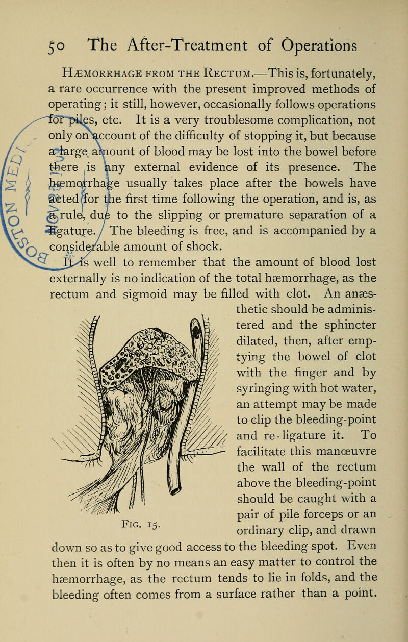 HEMORRHAGE FROM THE Rectum.—This is, fortunately, a rare occurrence with the present improved methods of operating; it still, however, occasionally follows operations ies, etc. It is a very troublesome complication, not Recount of the difficulty of stopping it, but because lount of blood may be lost into the bowel before Luy external evidence of its presence. The ^e usually takes place after the bowels have S^ted^or tjhe first time following the operation, and is, as to the slipping or premature separation of a The bleeding is free, and is accompanied by a conside/able amount of shock. ts well to remember that the amount of blood lost externally is no indication of the total haemorrhage, as the rectum and sigmoid may be filled with clot. An anaes- thetic should be adminis- tered and the sphincter dilated, then, after emp- tying the bowel of clot with the finger and by syringing with hot water, an attempt may be made to clip the bleeding-point and re-ligature it. To facilitate this manoeuvre the wall of the rectum above the bleeding-point should be caught with a pair of pile forceps or an ordinary clip, and drawn down so as to give good access to the bleeding spot. Even then it is often by no means an easy matter to control the haemorrhage, as the rectum tends to lie in folds, and the bleeding often comes from a surface rather than a point.