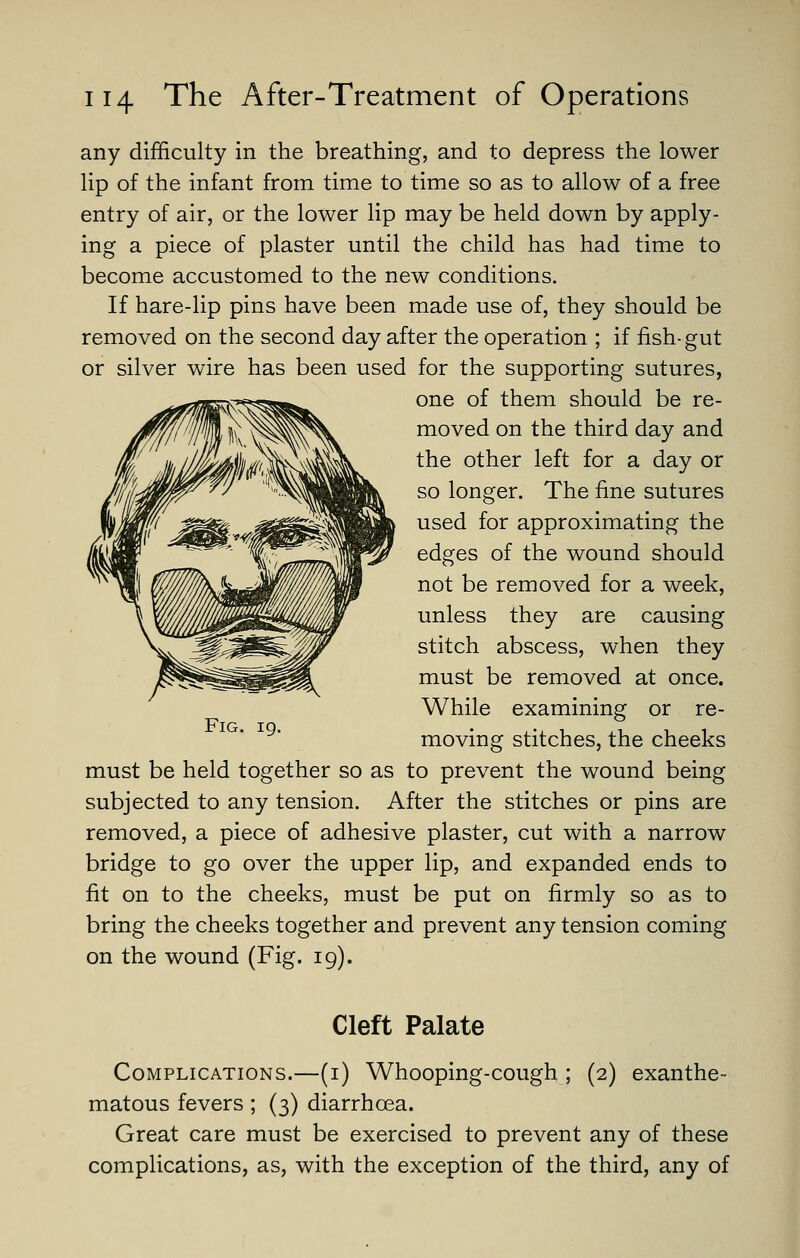 any difficulty in the breathing, and to depress the lower lip of the infant from time to time so as to allow of a free entry of air, or the lower lip may be held down by apply- ing a piece of plaster until the child has had time to become accustomed to the new conditions. If hare-lip pins have been made use of, they should be removed on the second day after the operation ; if fish-gut or silver wire has been used for the supporting sutures, one of them should be re- moved on the third day and the other left for a day or Ji[/i'I.^IKW^^y 'l^i^l^WBII^ so longer. The fine sutures used for approximating the edges of the wound should not be removed for a week, unless they are causing stitch abscess, when they must be removed at once. While examining or re- moving stitches, the cheeks must be held together so as to prevent the wound being subjected to any tension. After the stitches or pins are removed, a piece of adhesive plaster, cut with a narrow bridge to go over the upper lip, and expanded ends to fit on to the cheeks, must be put on firmly so as to bring the cheeks together and prevent any tension coming on the wound (Fig. 19). Cleft Palate Complications.—(i) Whooping-cough ; (2) exanthe- matous fevers ; (3) diarrhoea. Great care must be exercised to prevent any of these complications, as, with the exception of the third, any of