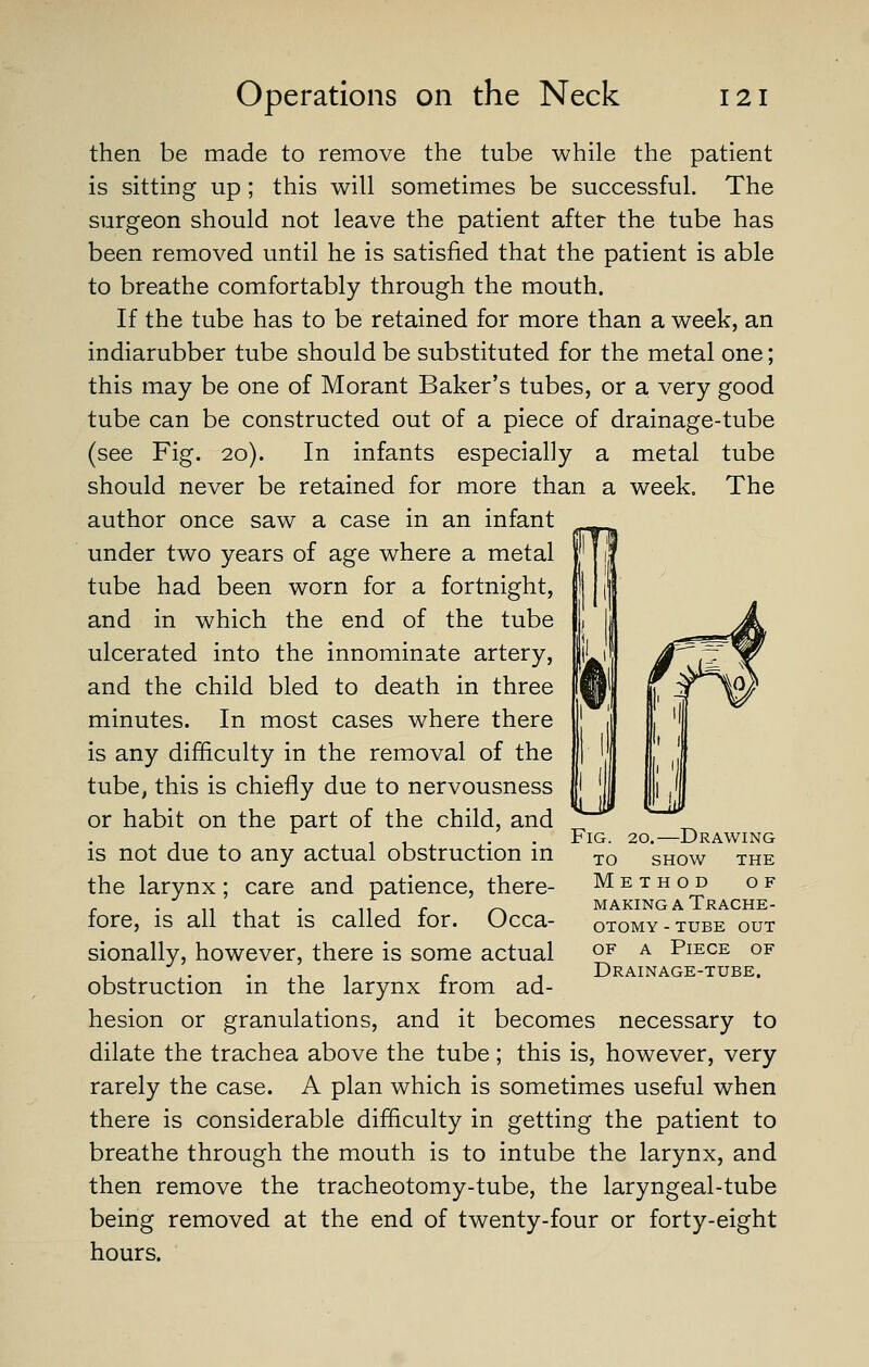 The then be made to remove the tube while the patient is sitting up; this will sometimes be successful. The surgeon should not leave the patient after the tube has been removed until he is satisfied that the patient is able to breathe comfortably through the mouth. If the tube has to be retained for more than a week, an indiarubber tube should be substituted for the metal one; this may be one of Morant Baker's tubes, or a very good tube can be constructed out of a piece of drainage-tube (see Fig. 20). In infants especially a metal tube should never be retained for more than a week author once saw a case in an infant under two years of age where a metal tube had been worn for a fortnight, and in which the end of the tube ulcerated into the innominate artery, and the child bled to death in three minutes. In most cases where there is any difficulty in the removal of the tube, this is chiefly due to nervousness or habit on the part of the child, and is not due to any actual obstruction in the larynx; care and patience, there- fore, is all that is called for. Occa- sionally, however, there is some actual obstruction in the larynx from ad- hesion or granulations, and it becomes necessary to dilate the trachea above the tube; this is, however, very rarely the case. A plan which is sometimes useful when there is considerable difficulty in getting the patient to breathe through the mouth is to intube the larynx, and then remove the tracheotomy-tube, the laryngeal-tube being removed at the end of twenty-four or forty-eight hours. d Fig. 20.—Drawing to show the Method of MAKING A Trache- otomy - TUBE OUT OF A Piece of Drainage-tube.