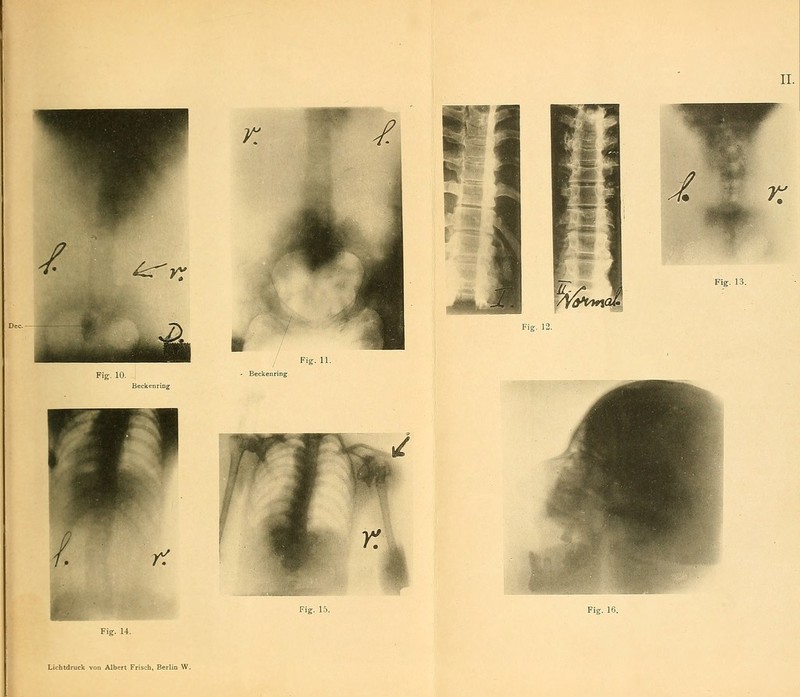 ^v. Fig. 11. Fi«. 10- ' Beckenring Beckenriog Fig. 12. Fig. 13. Fig. 1- Fig. 16. Lichtdruck von Albert Frisch, Berlin W.