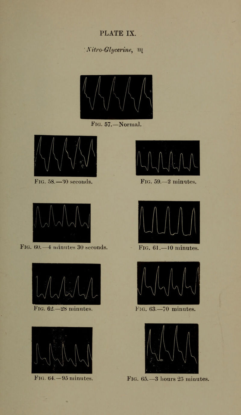 iMtro- Glycerine^ i J [ Fig. 57.—Normal. Fig. 58.—30 .seconds. Fig. 59.-2 minutes. Fig. 60.—4 minutes 30 seconds. Fig. 61.—10 minutes. Fig. 62.-28 minutes. Fig. 63.—70 minutes.
