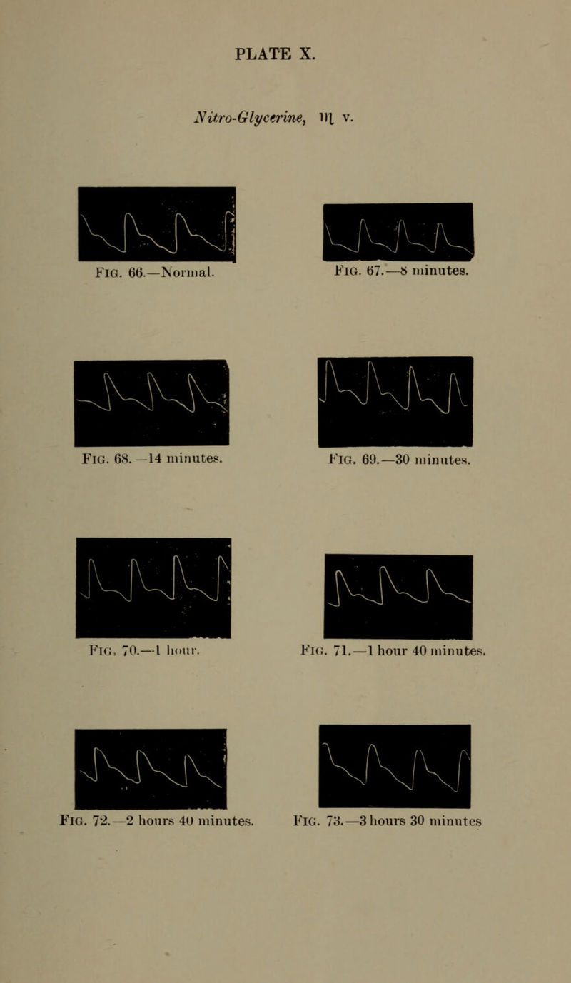 Nitro-Glycerine, ^^\ v. Fig. 66.—Normal. Fig. 67.—« minutes. Fig. 68. —14 minutes. Fig. 69.—30 minutes. Fig, 70.—I hour. Fig. 71.—1 hour 40 minutes. Fig. 72.—2 hours 40 minutes. F'lG. 73.—3 hours 30 minutes