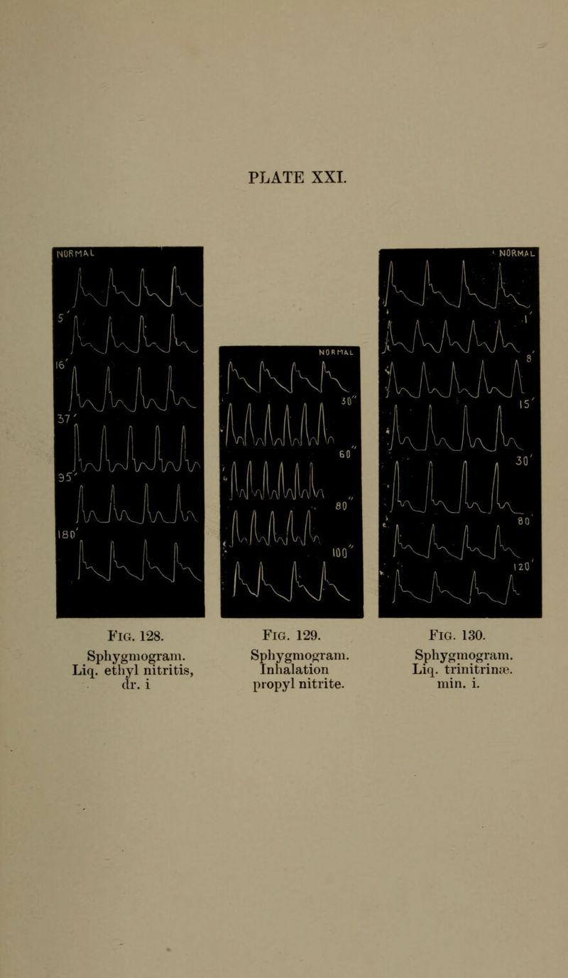 Fig. 128. Sphygniogram. Liq. ethyl nitritis, cir. i Fig. 129. Sphygniogram. Inlialation propyl nitrite. Fig. 130. Sphygniogram. Liq. trinitrinoe. min. i.