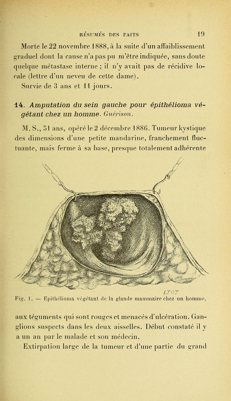 Morte le 22 novembre 1888, à la suite d'un affaiblissement graduel dont la cause n'a pas pu m'être indiquée, sans doute quelque métastase interne ; il n'y avait pas de récidive lo- cale (lettre d'un neveu de cette dame). Survie de 3 ans et 11 jours. 14, Amputation du sein gauche pour épithélioma vé- gétant chez un homme. Guérison, M. S., 51 ans, opéré le 2 décembre 1886. Tumeur kystique des dimensions d'une petite mandarine, franchement fluc- tuante, mais ferme à sa base, presque totalement adhérente LTor Fig. 1. — Epithélioma végétant de la glande mammaire chez un homme. aux téguments qui sont rouges et menacés d'ulcération. Gan- glions suspects dans les deux aisselles. Début constaté il y a un an par le malade et son médecin. Extirpation large de la tumeur et d'une partie du grand