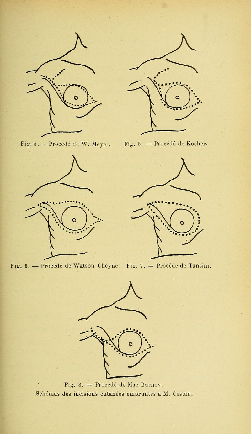 Fig. 4. — Procédé de W. Meycr. Fig. 5. — Procédé de Koclier. Fig. 6. — Procédé de Watson Gheyne. Fig. 7. — Procédé de Tansini. Fig. 8. — Procédé de Mac Burney. Schémas des incisions cutanées empruntés à M. Gestan.