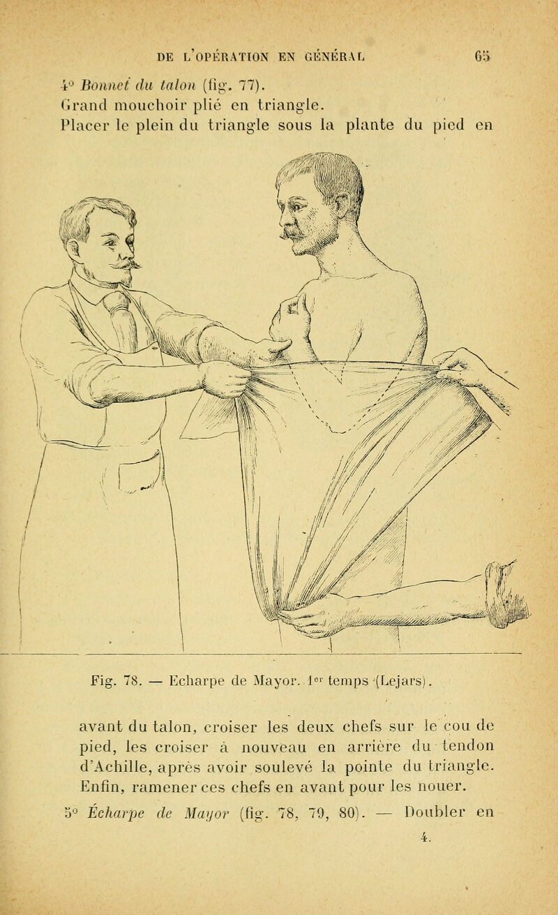 4° Bonnet du talon (fîg. 77). Grand mouchoir plié en triangle. Placer le plein du triangle sous la plante du pied en Fig. 78. — Echarpe de Mayor. 1er temps (Lejars). avant du talon, croiser les deux chefs sur le cou de pied, les croiser à nouveau en arrière du tendon d'Achille, après avoir soulevé la pointe du triangle. Enfin, ramener ces chefs en avant pour les nouer. o° Éeharpe de Mayor (fig. 78, 79, 80). — Doubler en